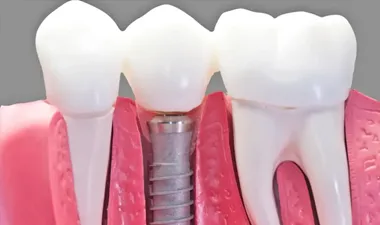 کلینیک ایمپلنت