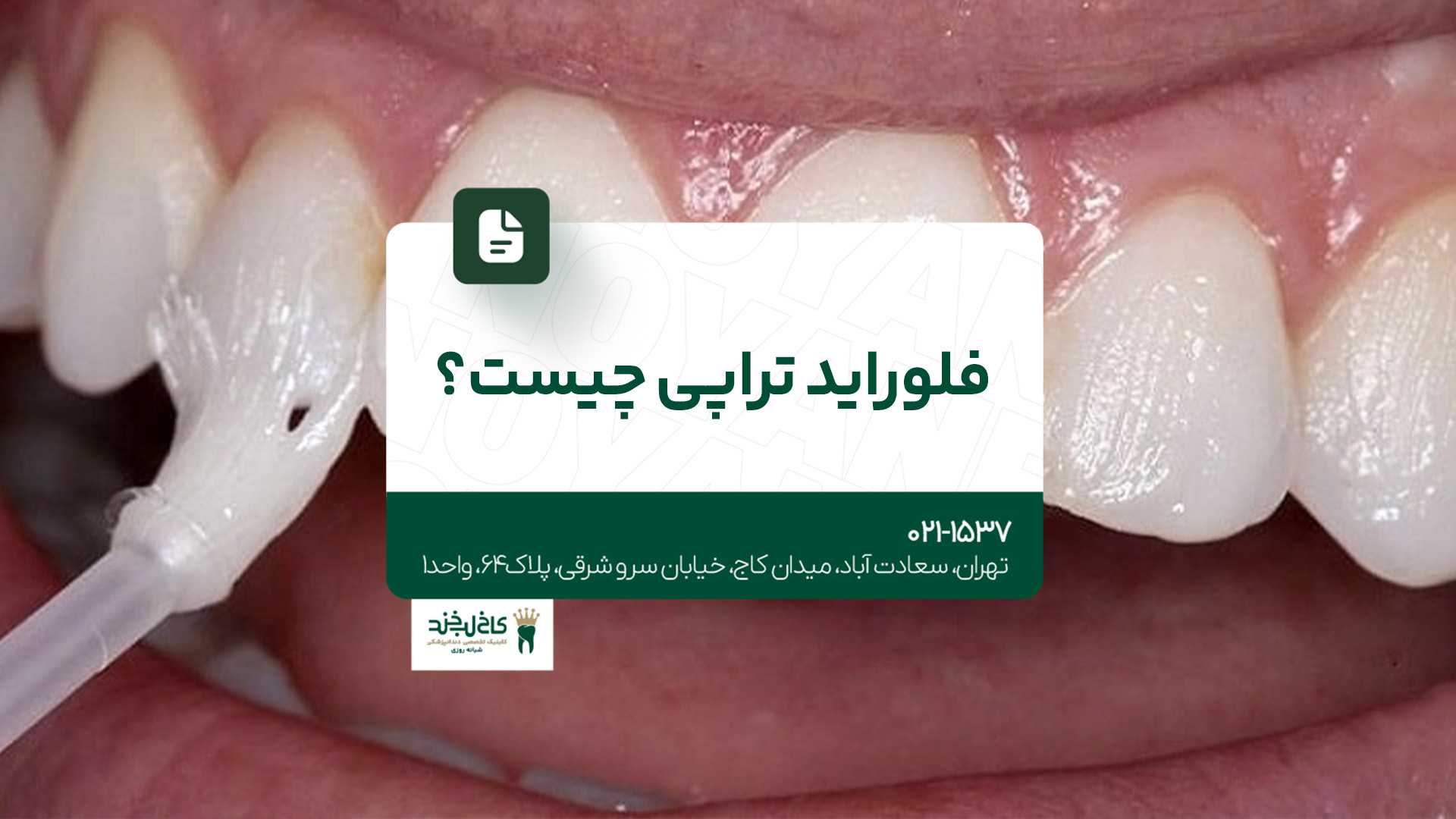 فلوراید تراپی چیست؟ فلوراید تراپی چیست؟