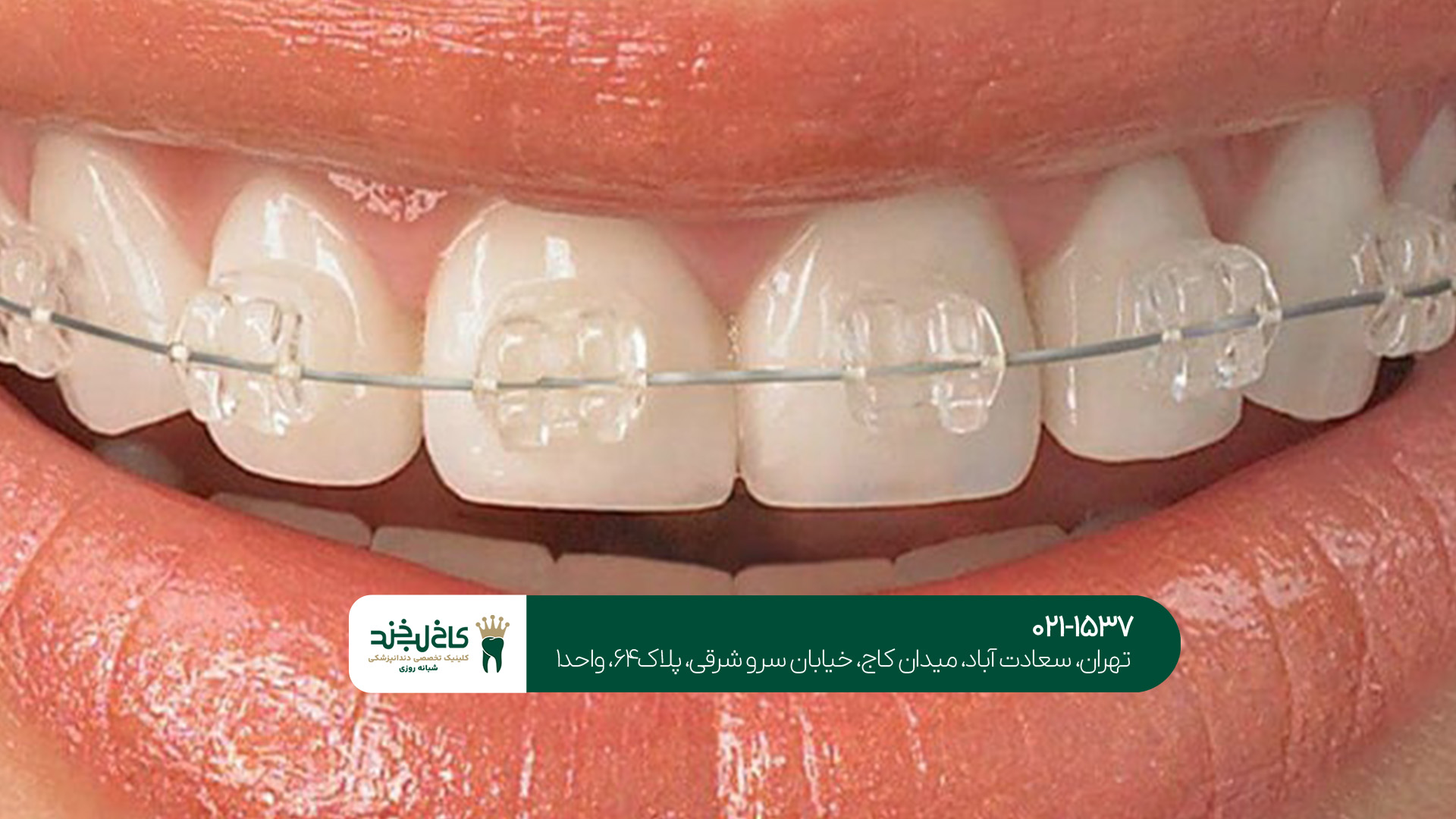 قیمت ارتودنسی نامرئی تهران