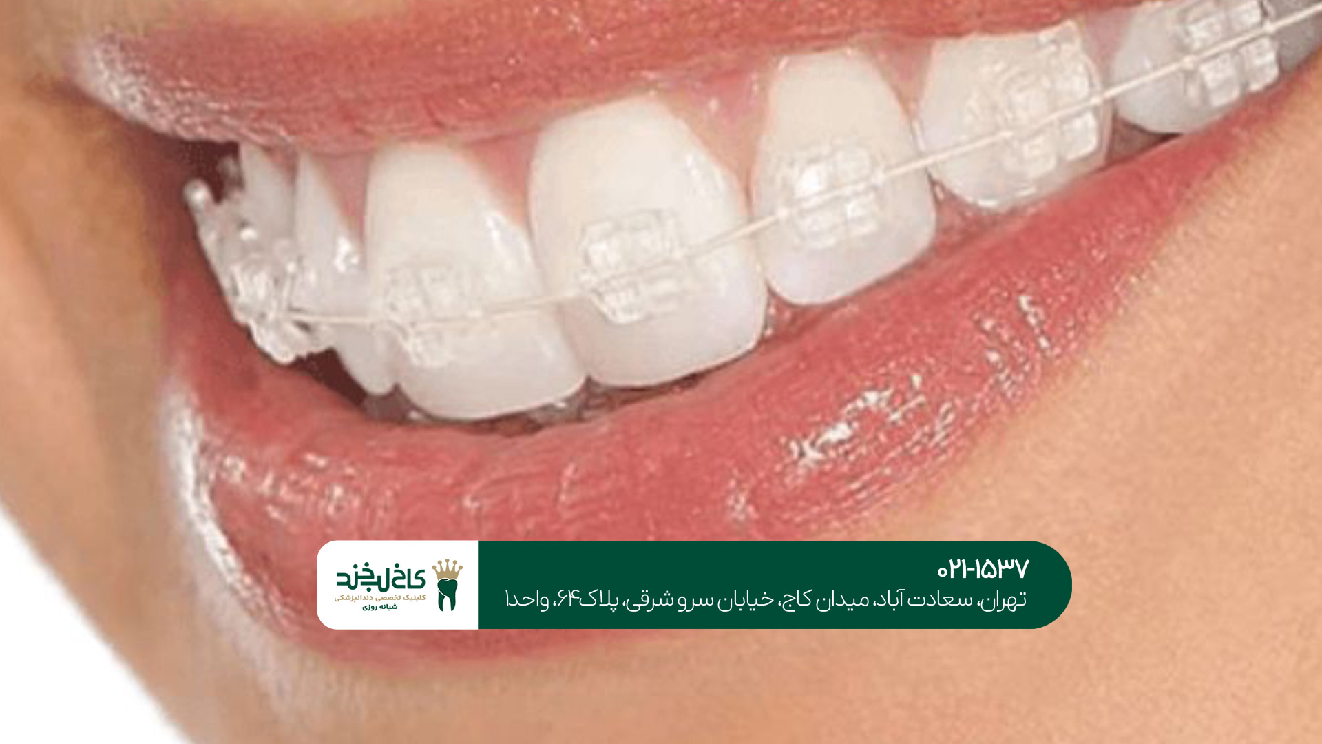 قیمت ارتودنسی نامرئی تهران