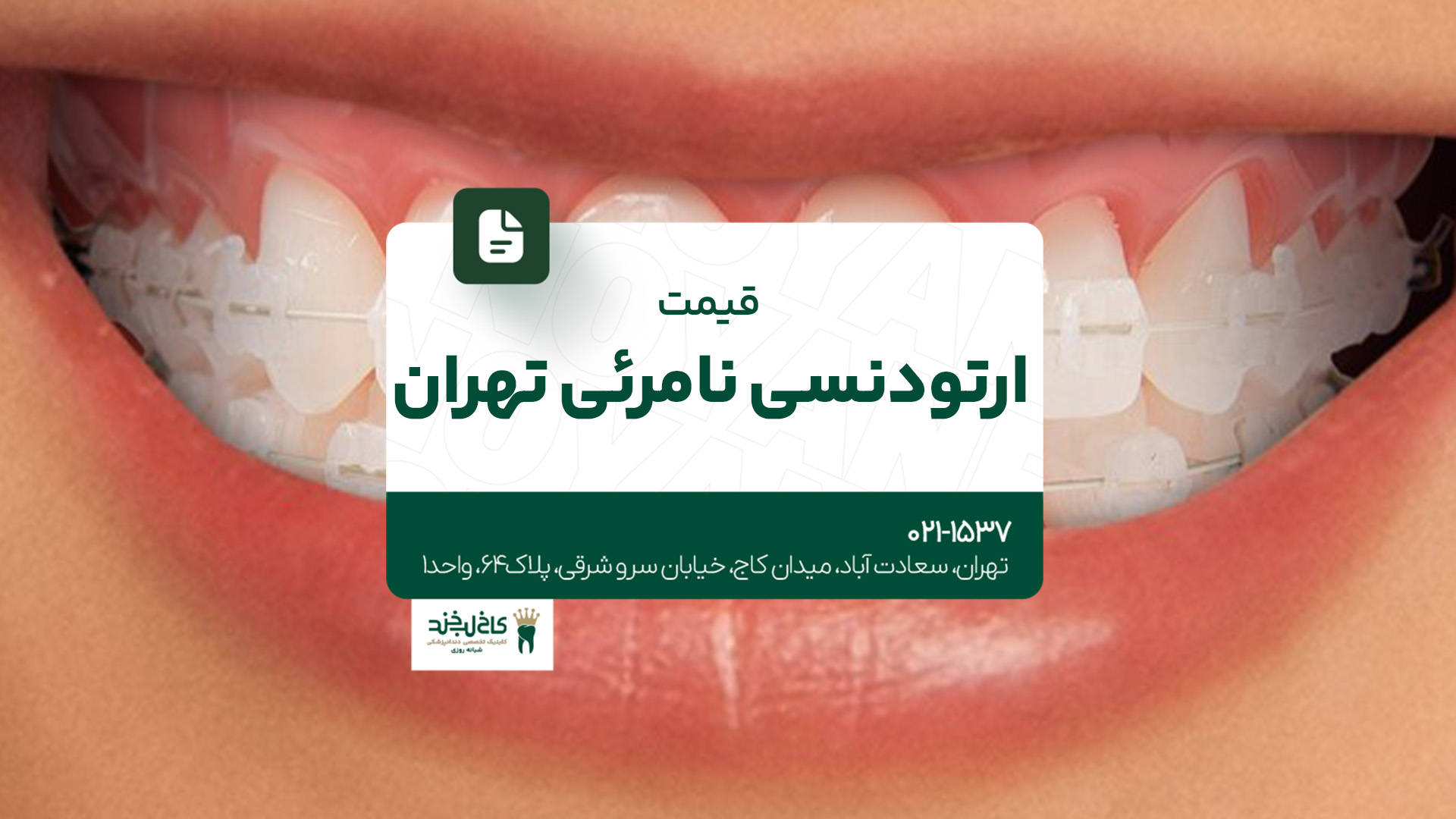 قیمت ارتودنسی نامرئی تهران