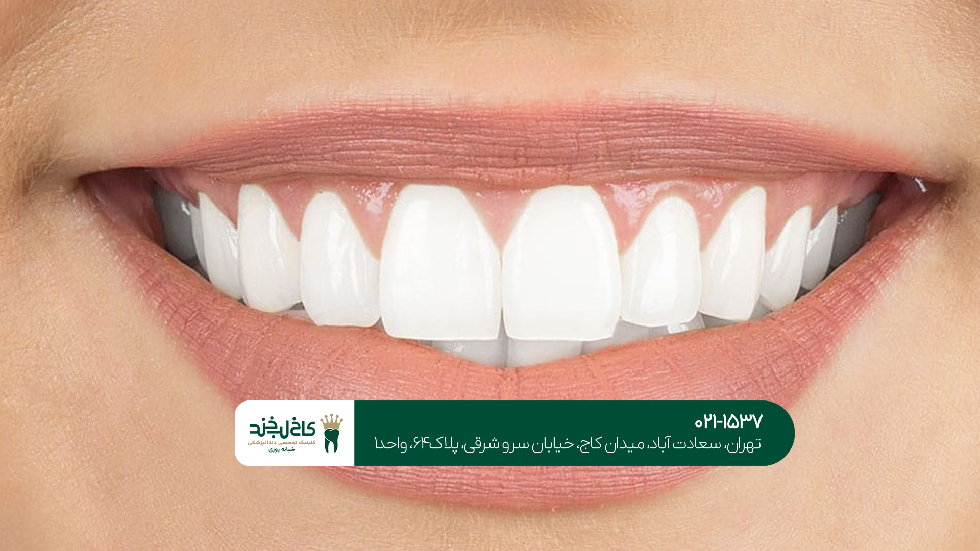 لمینت دندان در سعادت آباد لمینت دندان در سعادتآباد