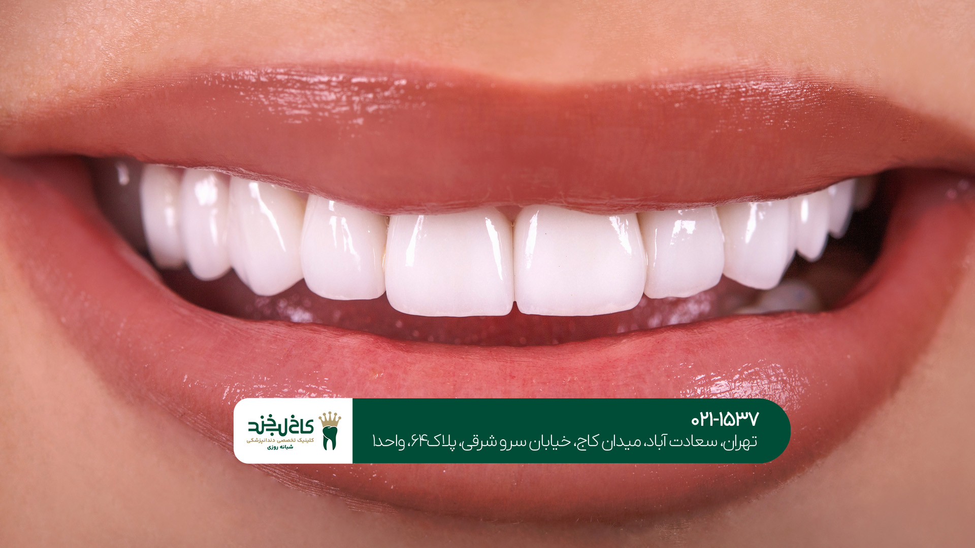 لمینت دندان در سعادت آباد لمینت دندان در سعادت آباد