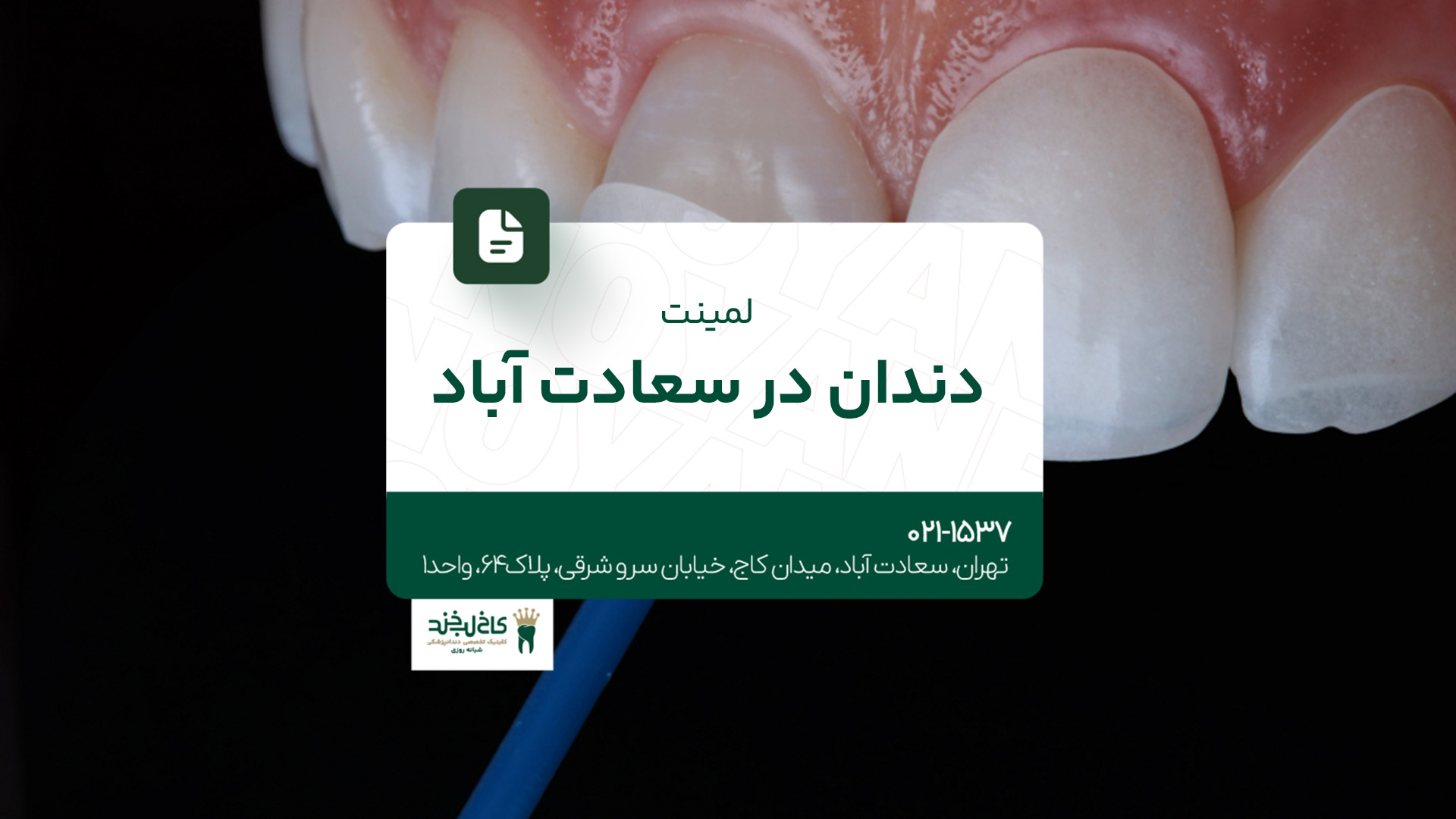 لمینت دندان در سعادت آباد لمینت دندان در سعادت آباد