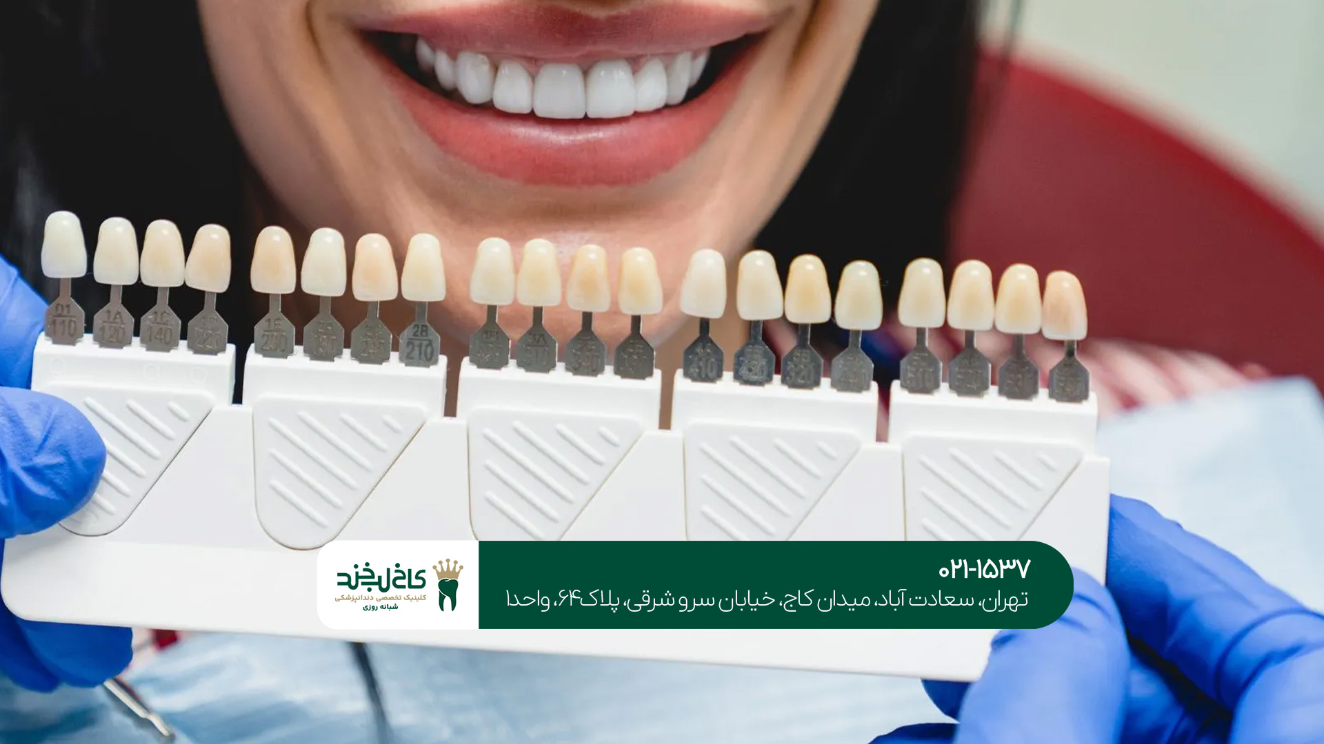 لمینت دندان طبیعی در تهران