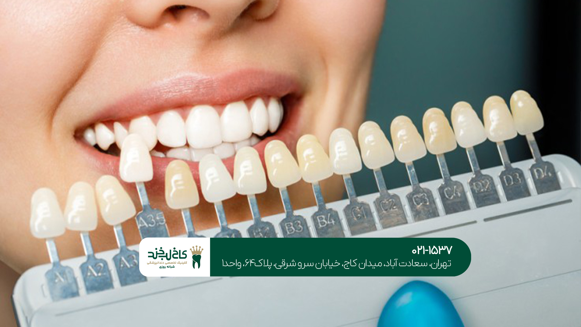 لمینت دندان طبیعی در تهران