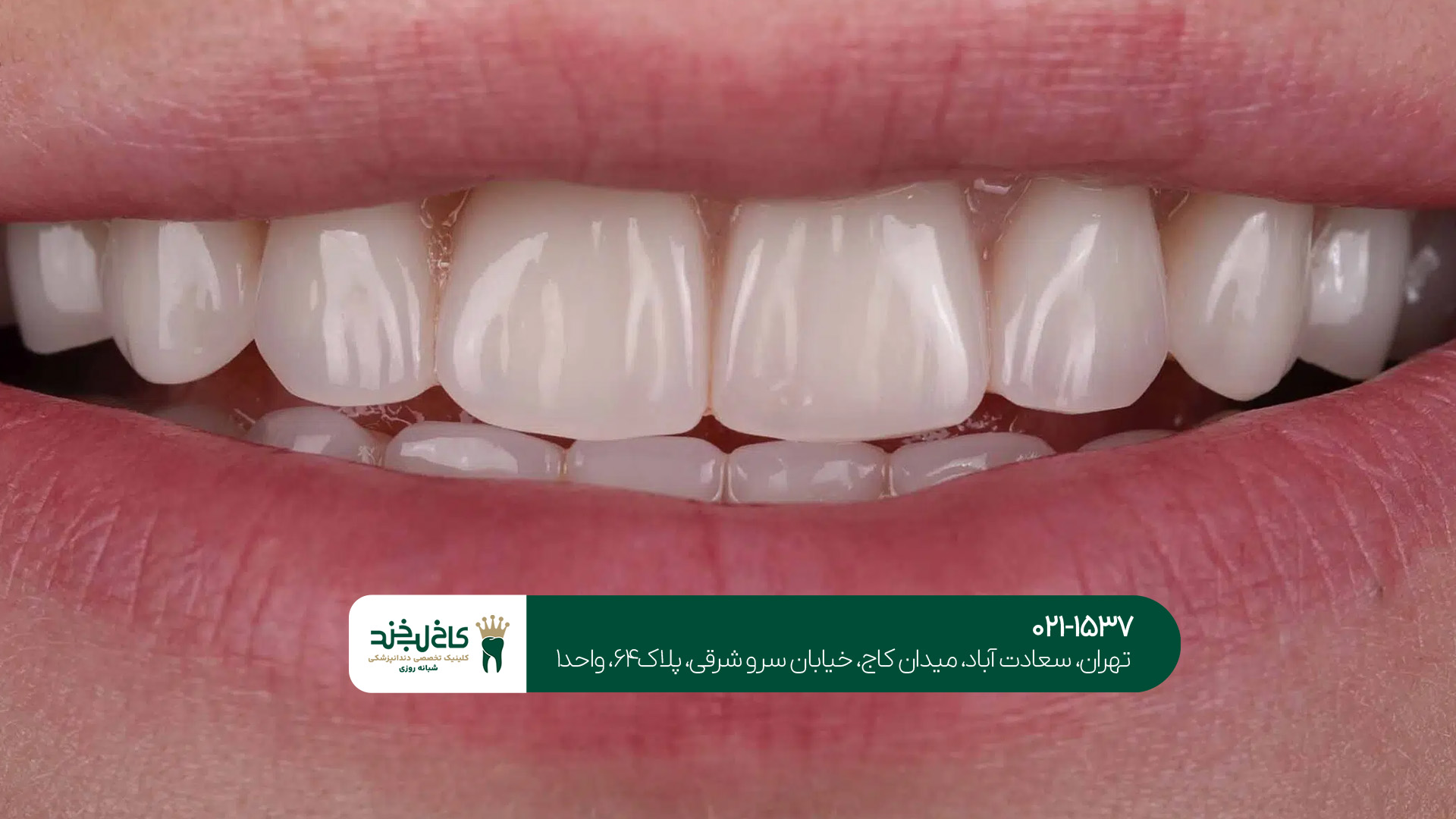 لمینت سرامیکی لمینت سرامیکی