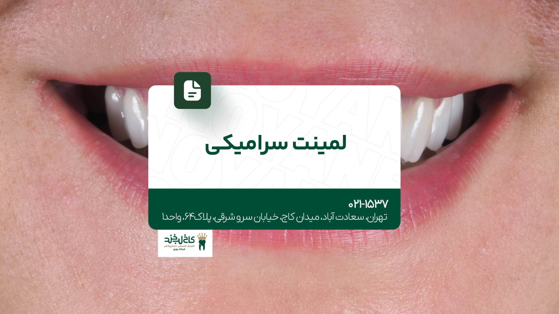 لمینت سرامیکی لمینت سرامیکی