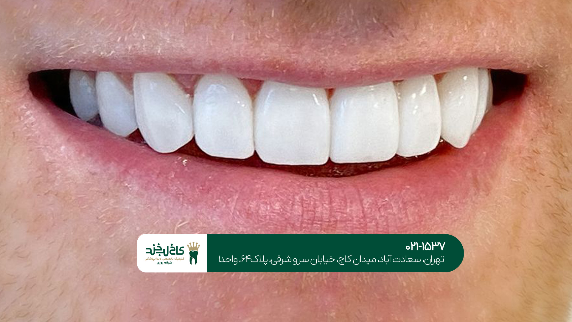 لمینت و کامپوزیت در تهران لمینت و کامپوزیت در تهران