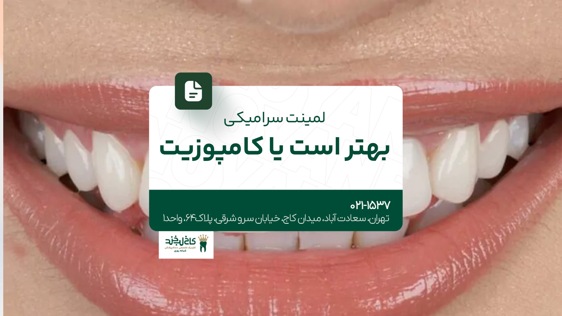 لمینت سرامیکی بهتر است یا کامپوزیت لمینت سرامیکی بهتر است یا کامپوزیت
