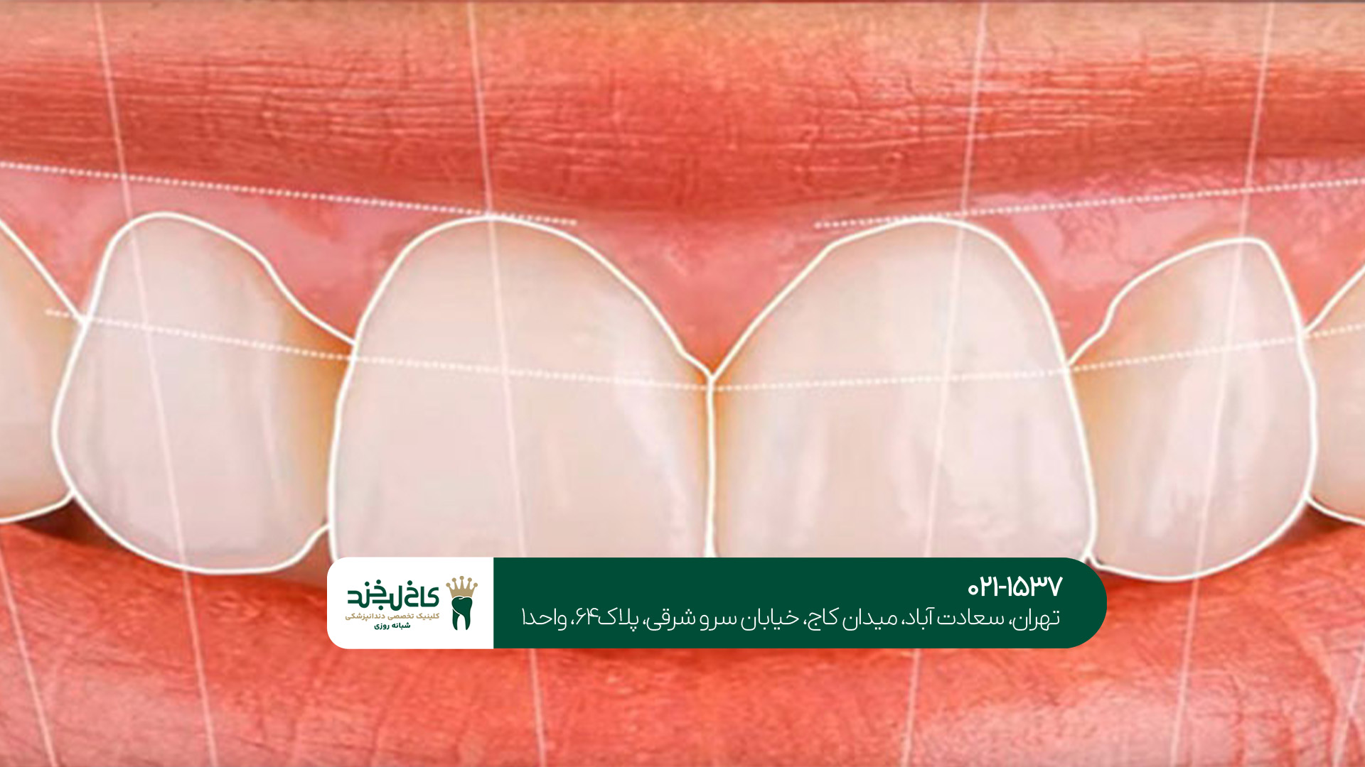 مراحل طراحی لبخند دیجیتال مراحل طراحی لبخند دیجیتال