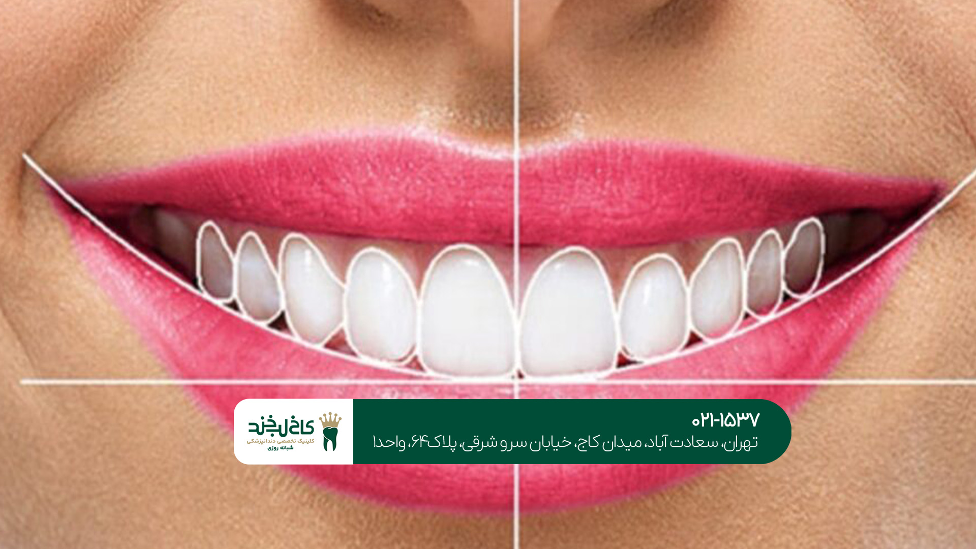 مراحل طراحی لبخند دیجیتال مراحل طراحی لبخند دیجیتال