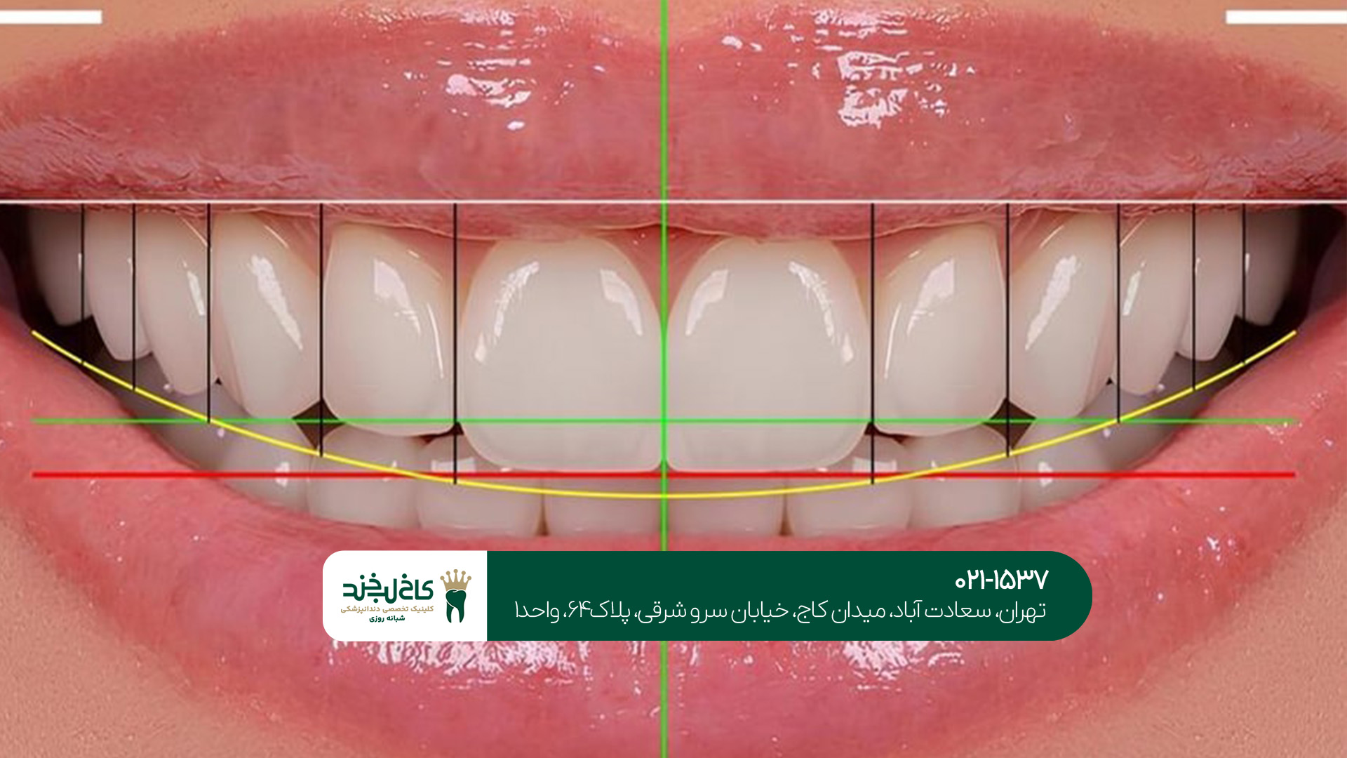 مراحل طراحی لبخند دیجیتال مراحل طراحی لبخند دیجیتال