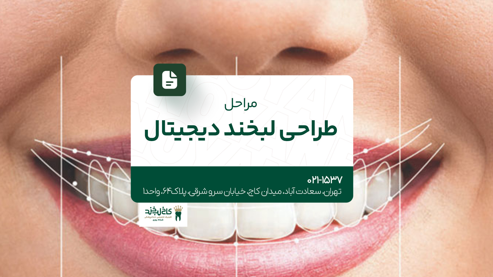 مراحل طراحی لبخند دیجیتال مراحل طراحی لبخند دیجیتال