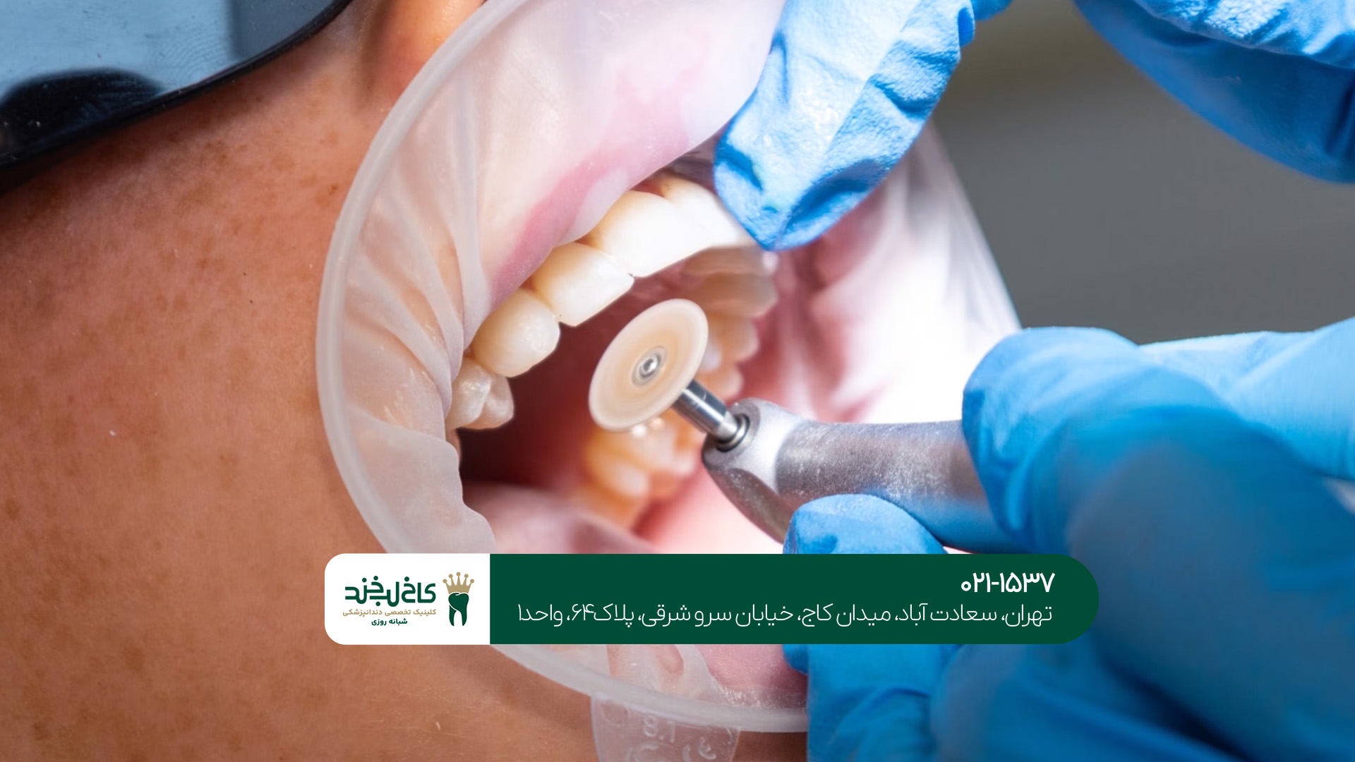 مراقبت بعد از کامپوزیت دندان