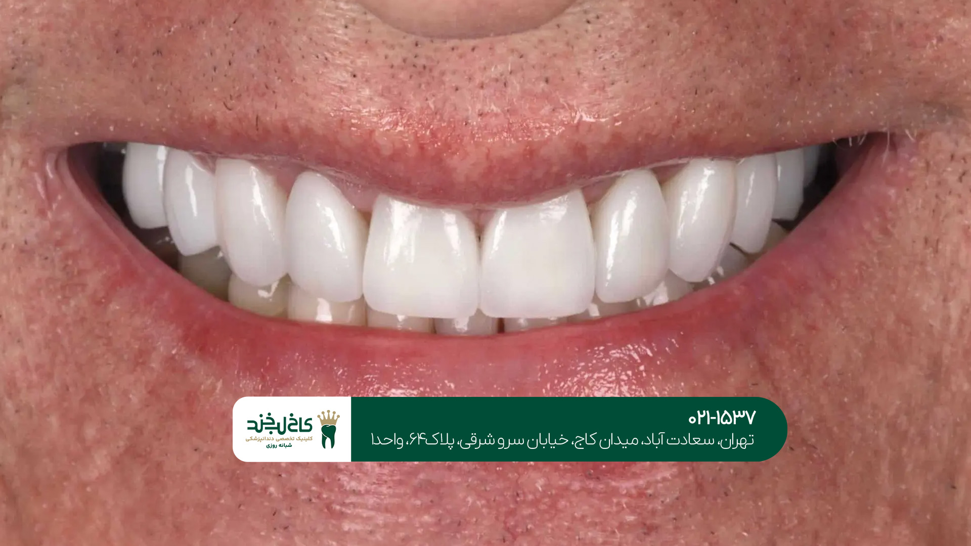 مراقبت بعد از کامپوزیت دندان