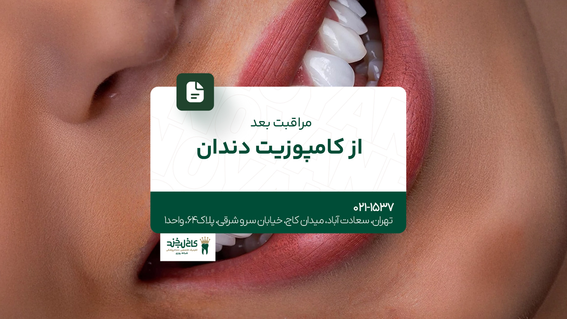 مراقبت بعد از کامپوزیت دندان