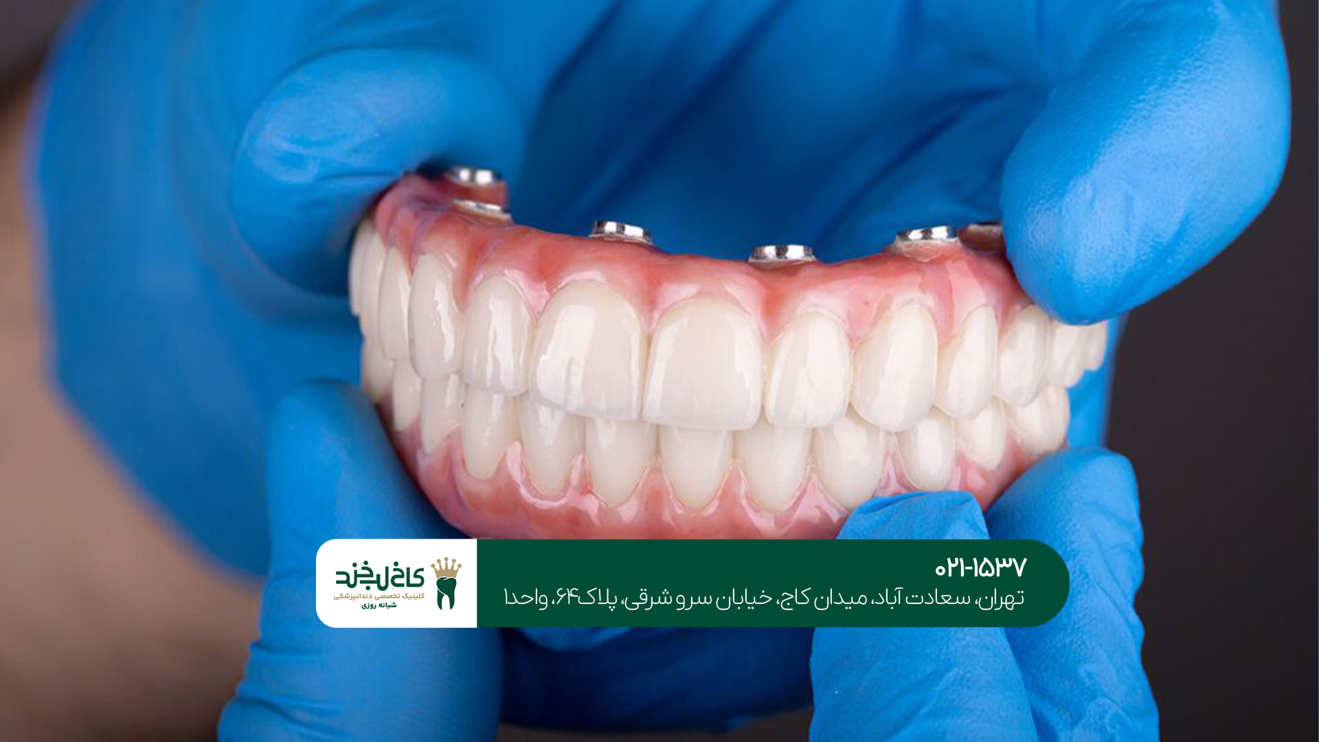 مراقبت های بعد از پروتز دندان مراقبت های بعد از پروتز دندان