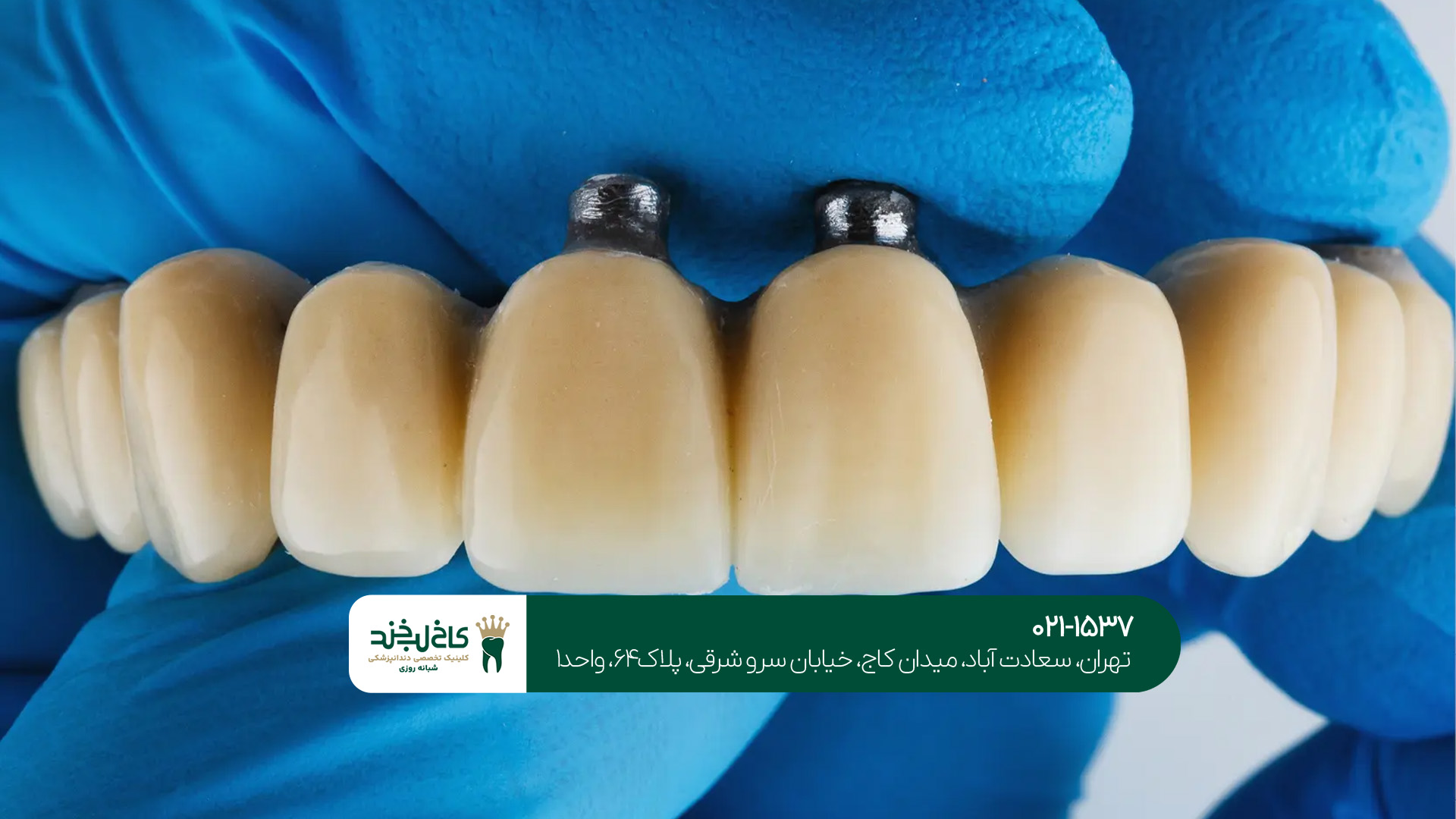 مراقبت های بعد از پروتز دندان مراقبت های بعد از پروتز دندان