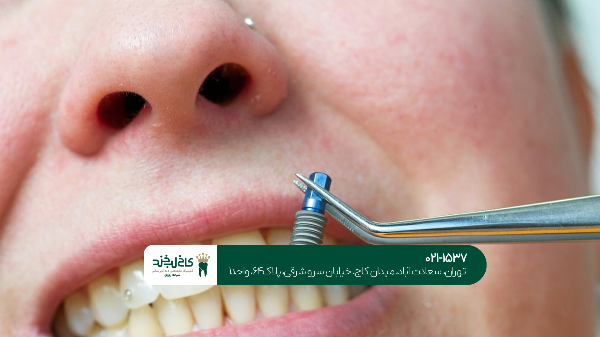 مرکز ایمپلنت دندان شبانه روزی مرکز ایمپلنت دندان شبانه روزی