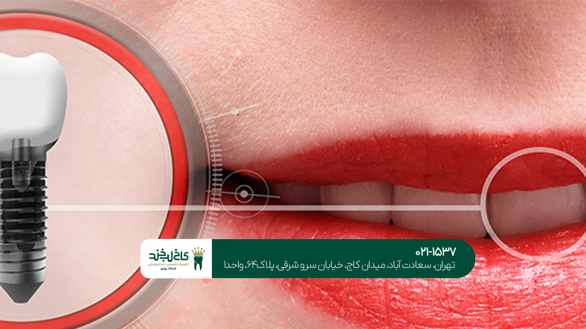 مرکز ایمپلنت دندان شبانه روزی مرکز ایمپلنت دندان شبانه روزی