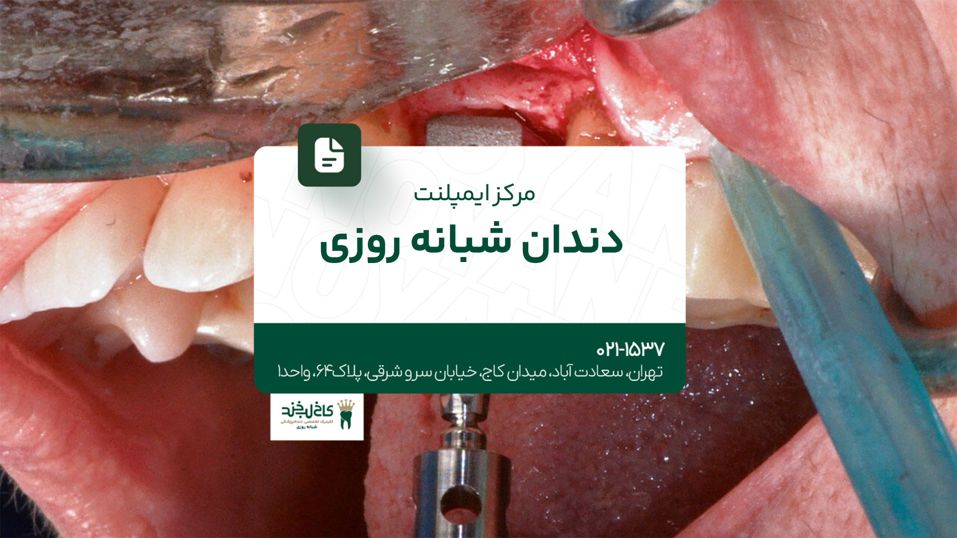 مرکز ایمپلنت دندان شبانه روزی مرکز ایمپلنت دندان شبانهروزی