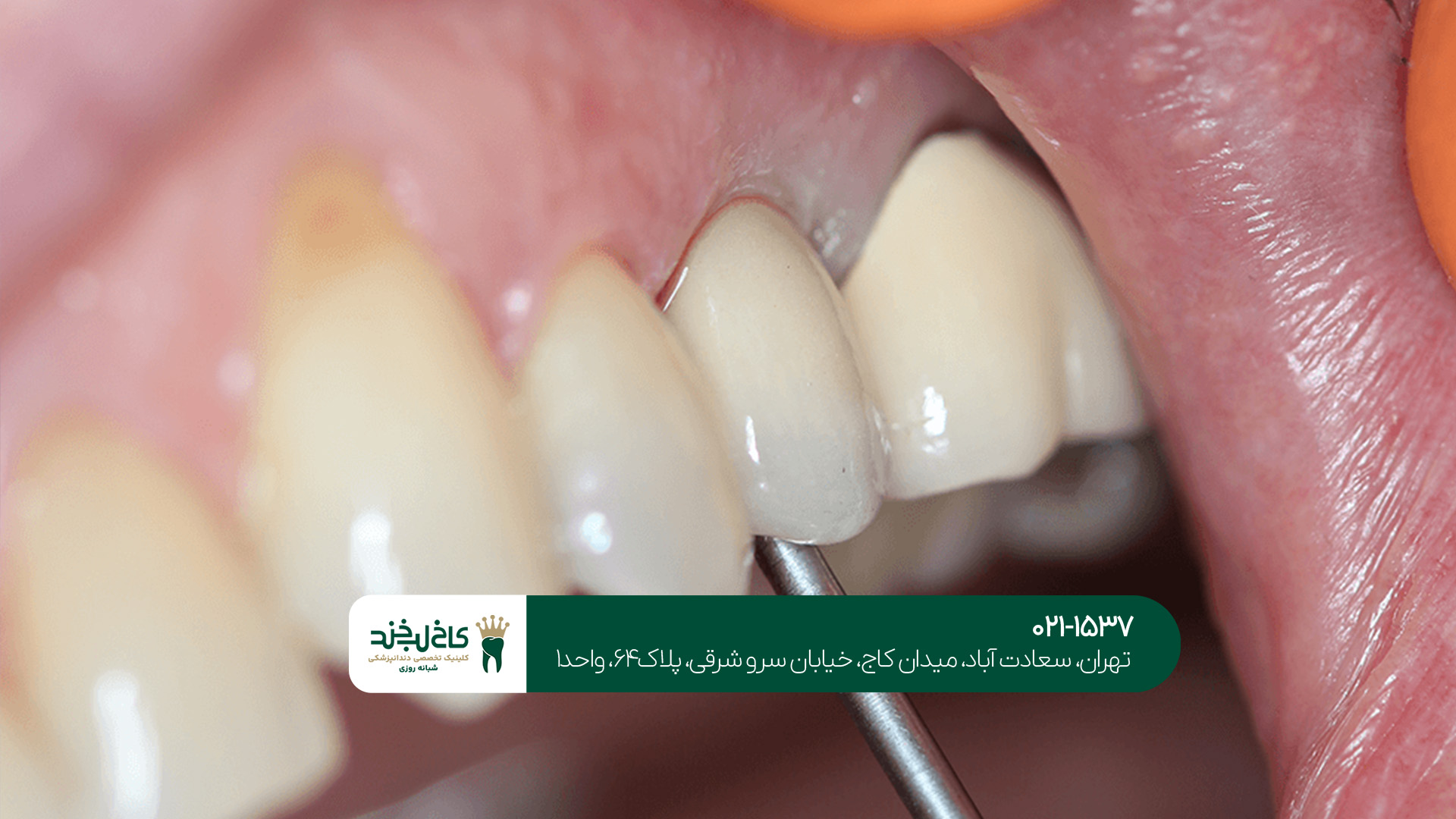 مرکز ایمپلنت بدون درد و دیجیتال تهران مرکز ایمپلنت بدون درد و دیجیتال تهران