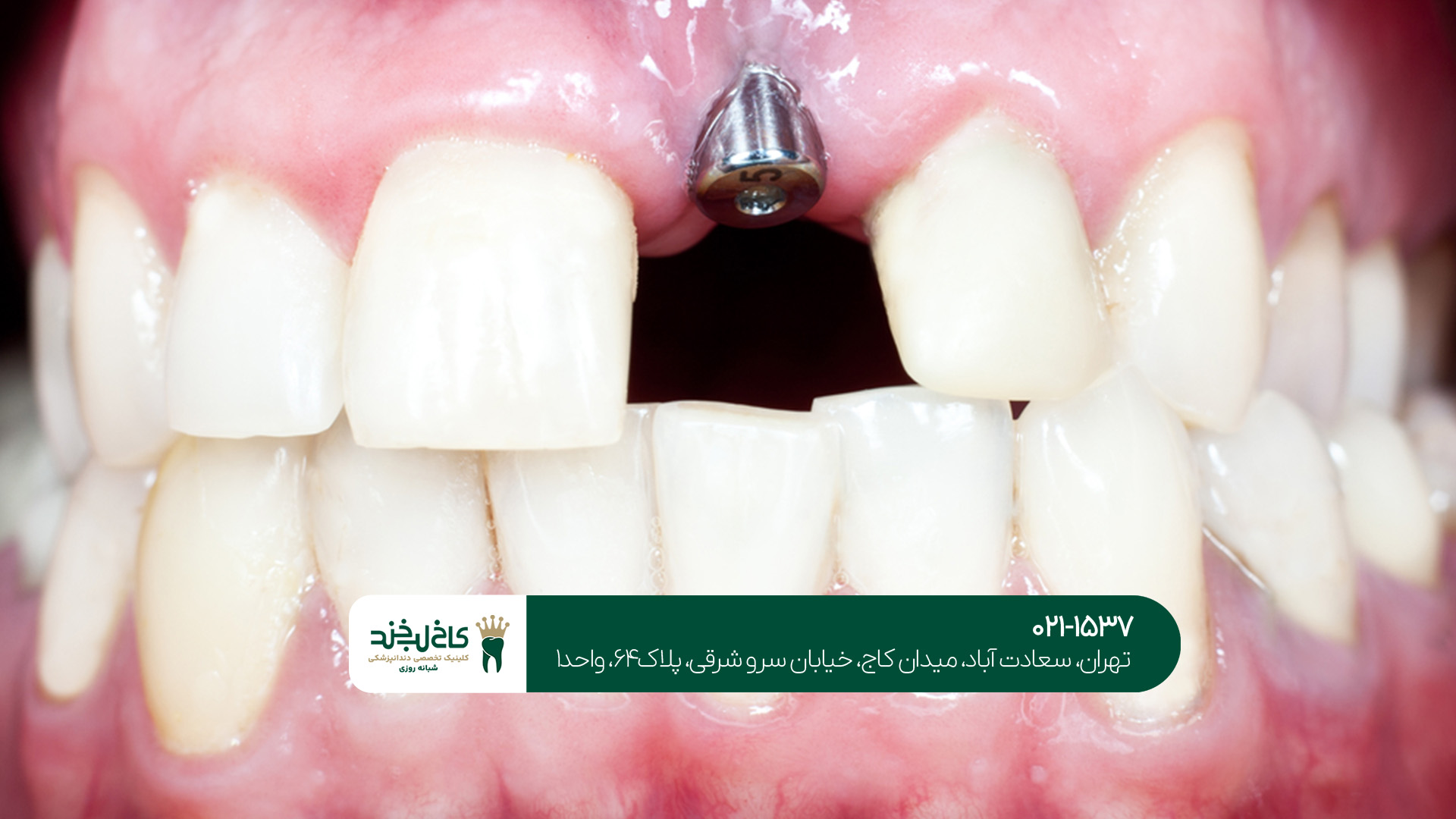 مرکز ایمپلنت بدون درد و دیجیتال تهران مرکز ایمپلنت بدون درد و دیجیتال تهران