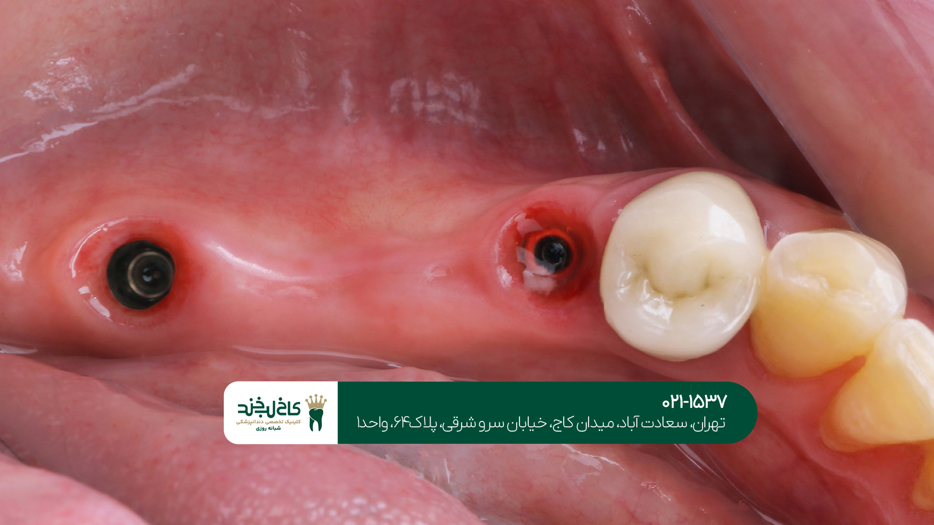 مرکز ایمپلنت بدون درد و دیجیتال تهران مرکز ایمپلنت بدون درد و دیجیتال تهران