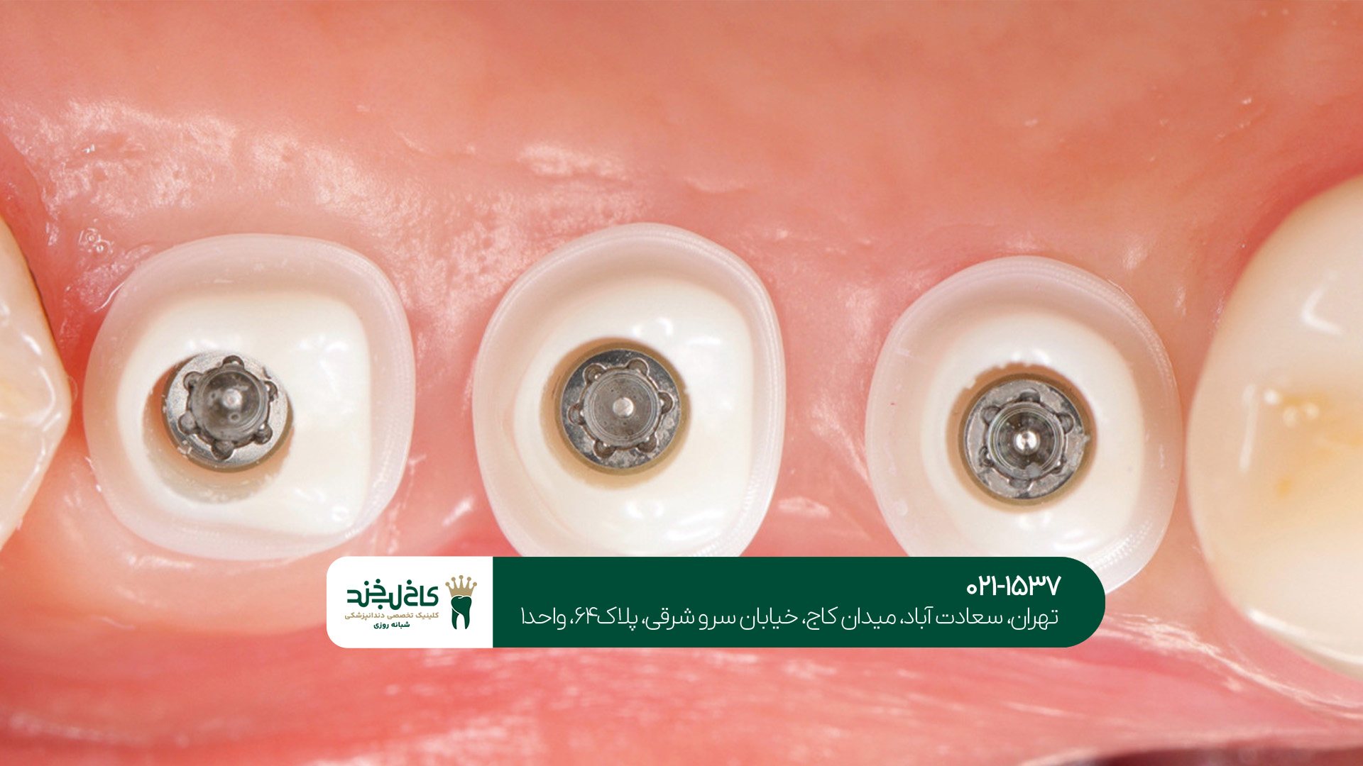 مرکز ایمپلنت دندان شبانه روزی مرکز ایمپلنت دندان شبانه روزی