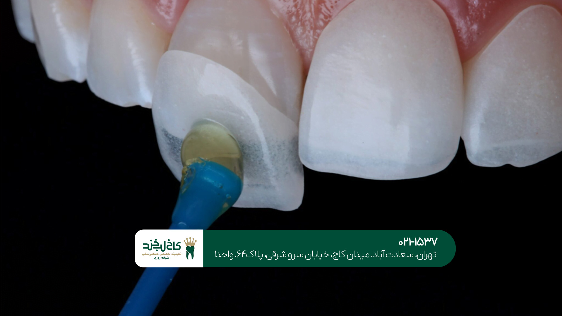 مزایا و معایب لمینت دندان مزایا و معایب لمینت دندان