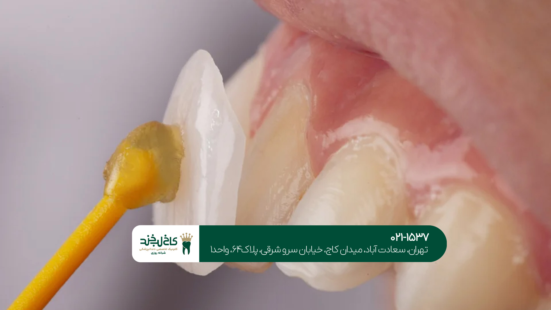 مزایا و معایب لمینت دندان مزایا و معایب لمینت دندان