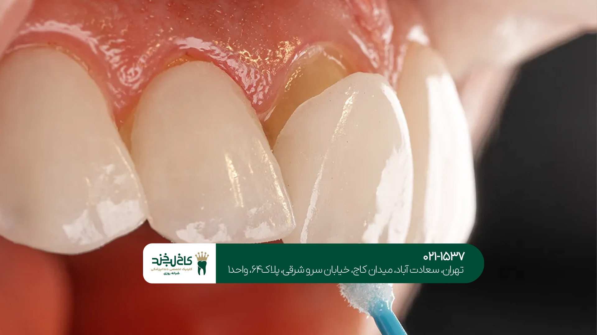 مزایا و معایب لمینت دندان مزایا و معایب لمینت دندان