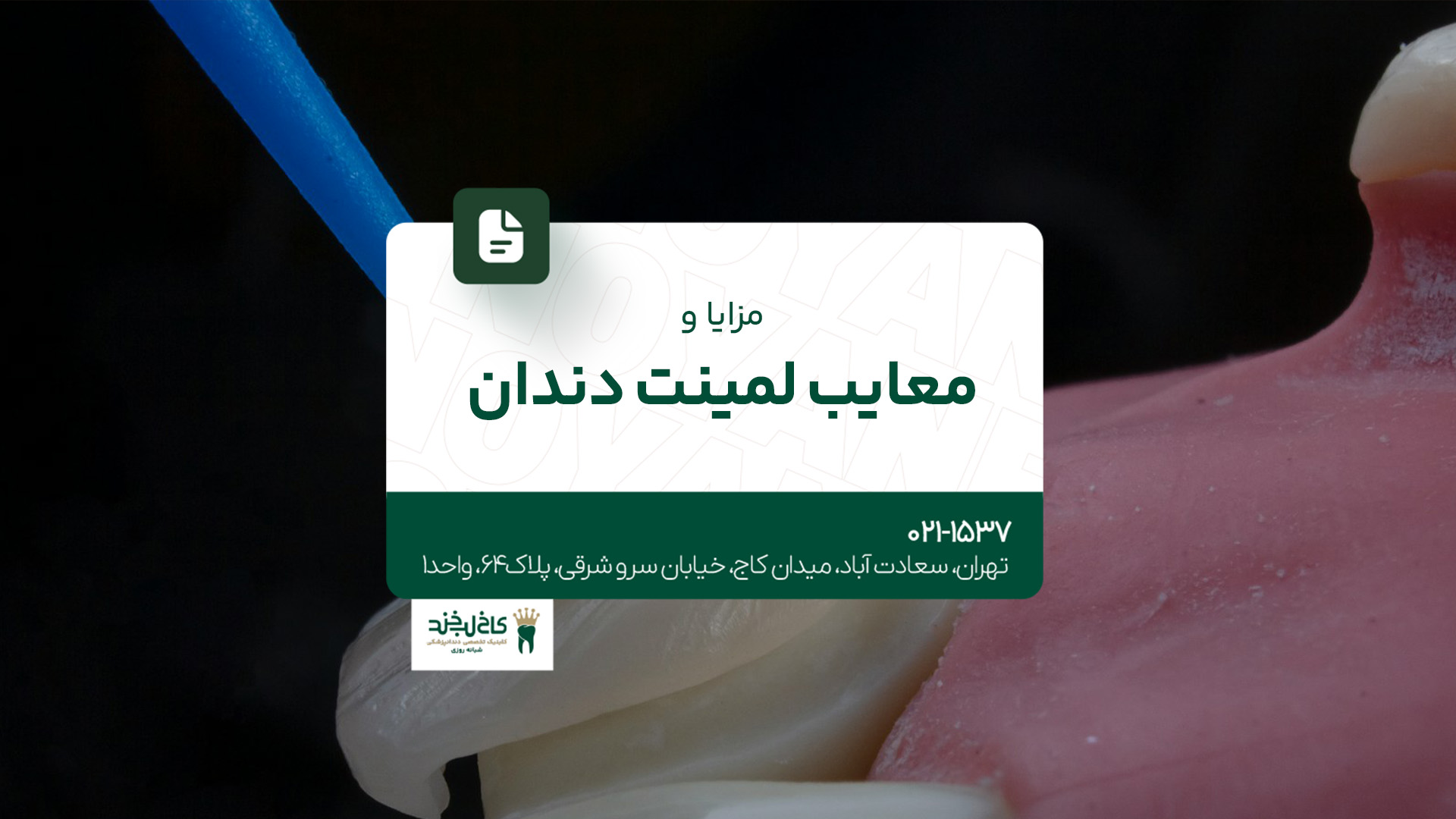 مزایا و معایب لمینت دندان مزایا و معایب لمینت دندان