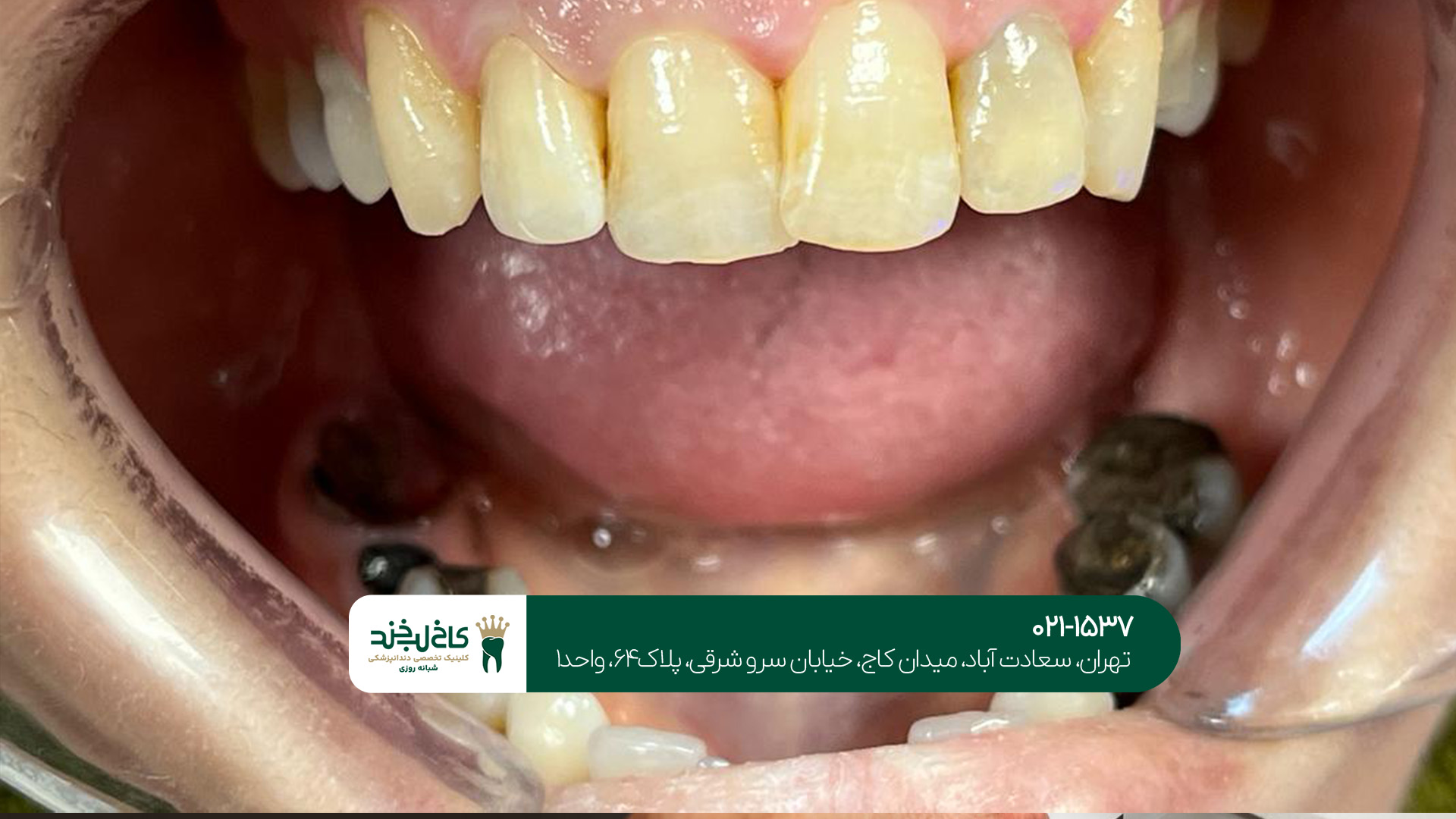 معرفی کامل ایمپلنت دیجیتال معرفی کامل ایمپلنت دیجیتال