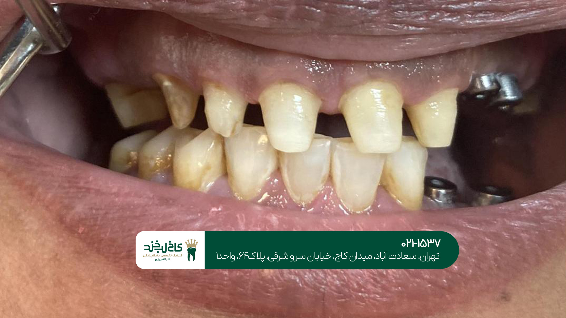 معرفی کامل ایمپلنت دیجیتال معرفی کامل ایمپلنت دیجیتال