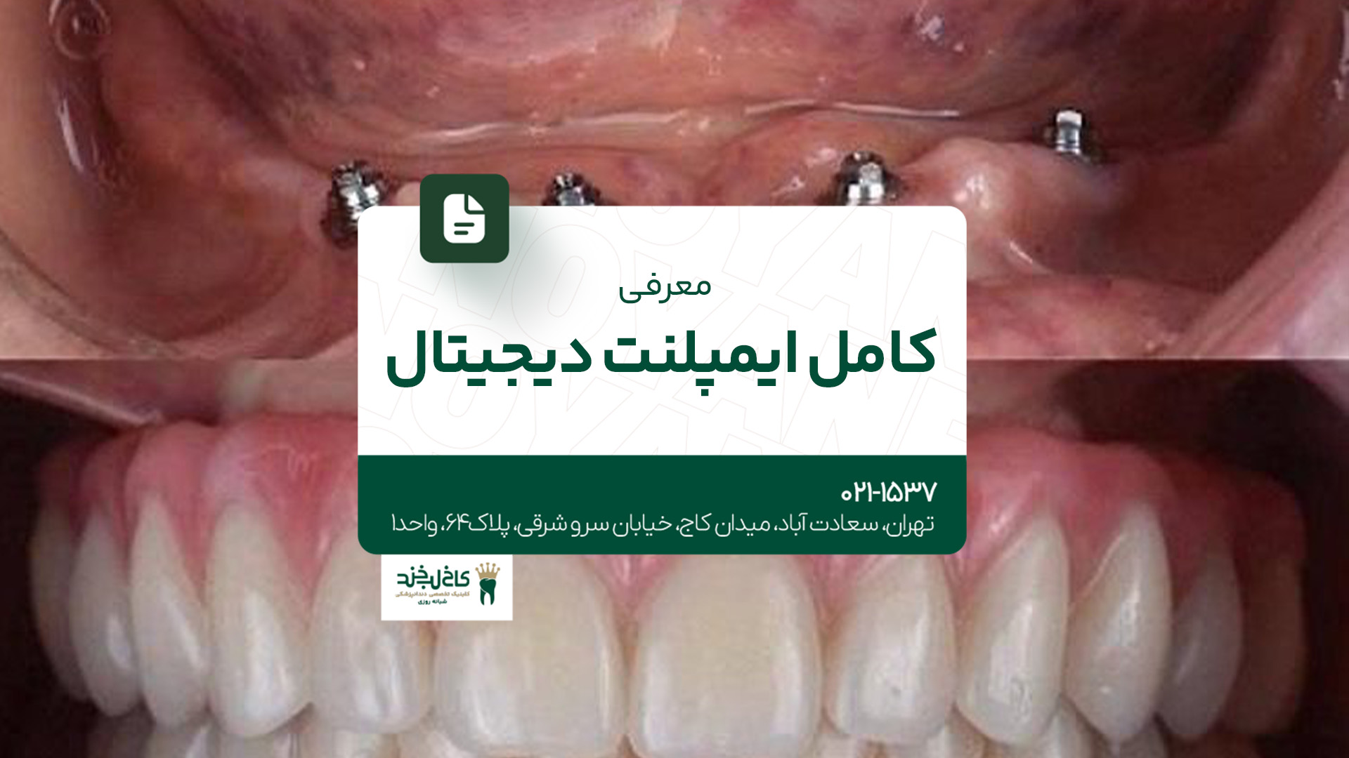 معرفی کامل ایمپلنت دیجیتال معرفی کامل ایمپلنت دیجیتال