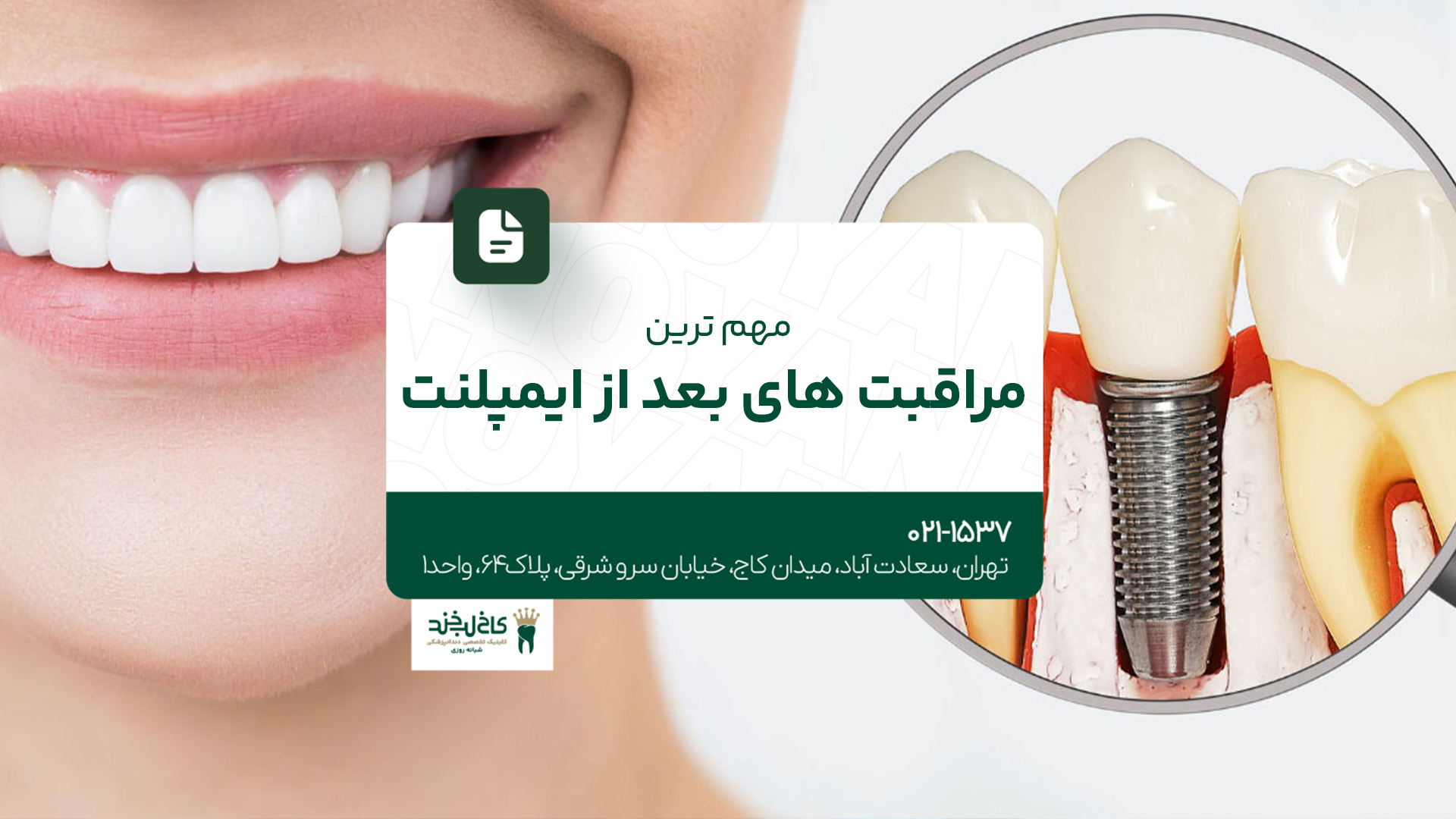 مهمترین نکات مراقبتی بعد از ایمپلنت دندان مهمترین نکات مراقبتی بعد از ایمپلنت دندان