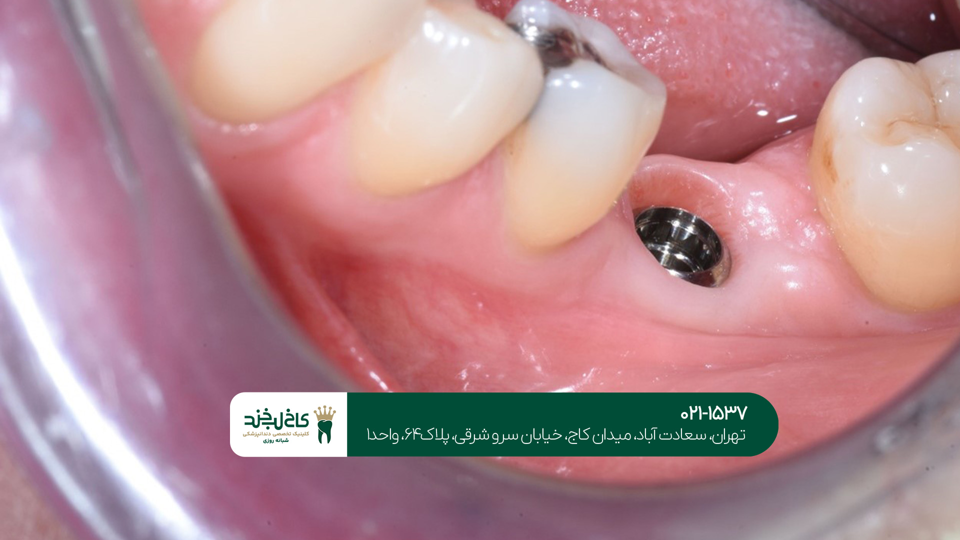 مهمترین نکات مراقبتی بعد از ایمپلنت دندان مهمترین نکات مراقبتی بعد از ایمپلنت دندان