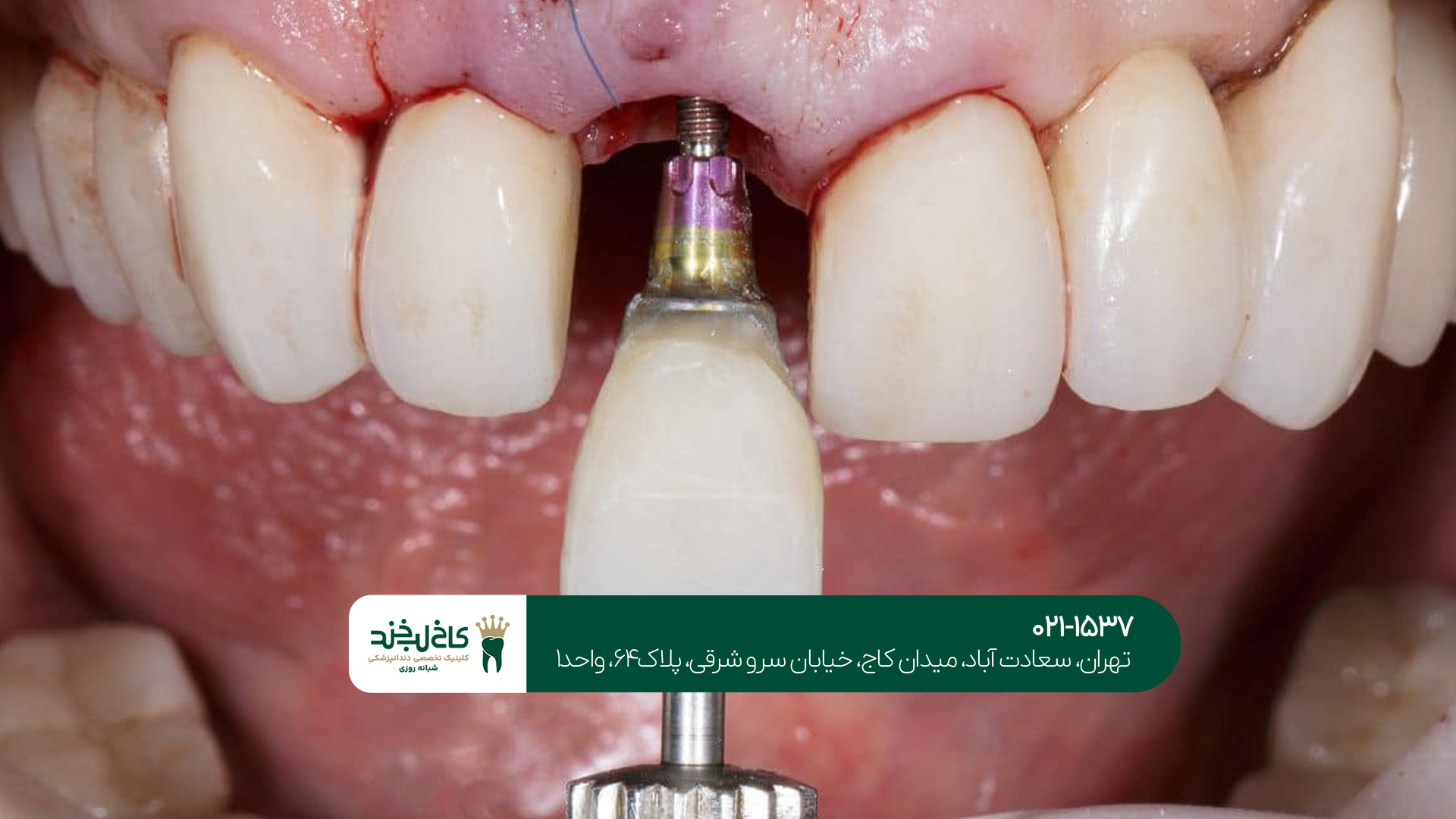 مهمترین نکات مراقبتی بعد از ایمپلنت دندان مهمترین نکات مراقبتی بعد از ایمپلنت دندان