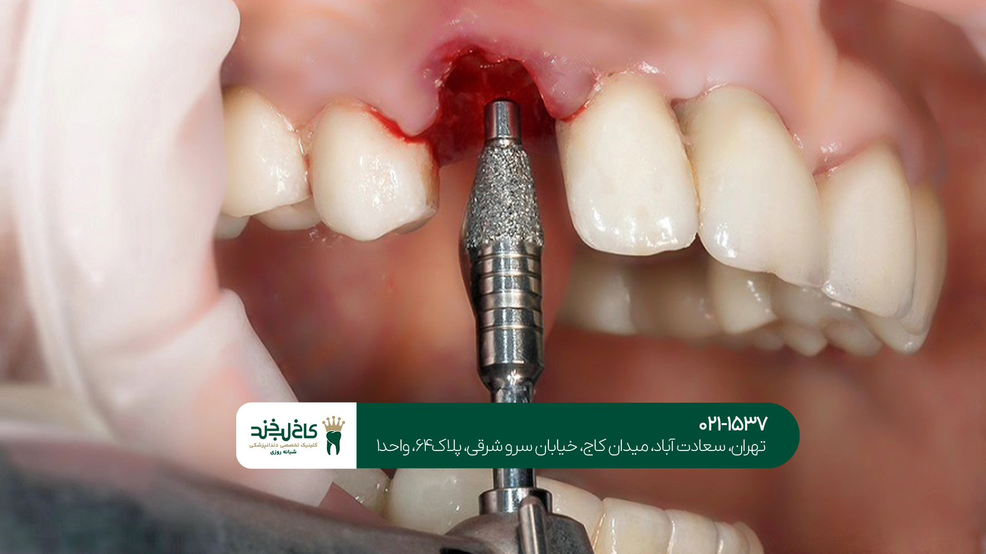 مهمترین نکات مراقبتی بعد از ایمپلنت دندان مهمترین نکات مراقبتی بعد از ایمپلنت دندان