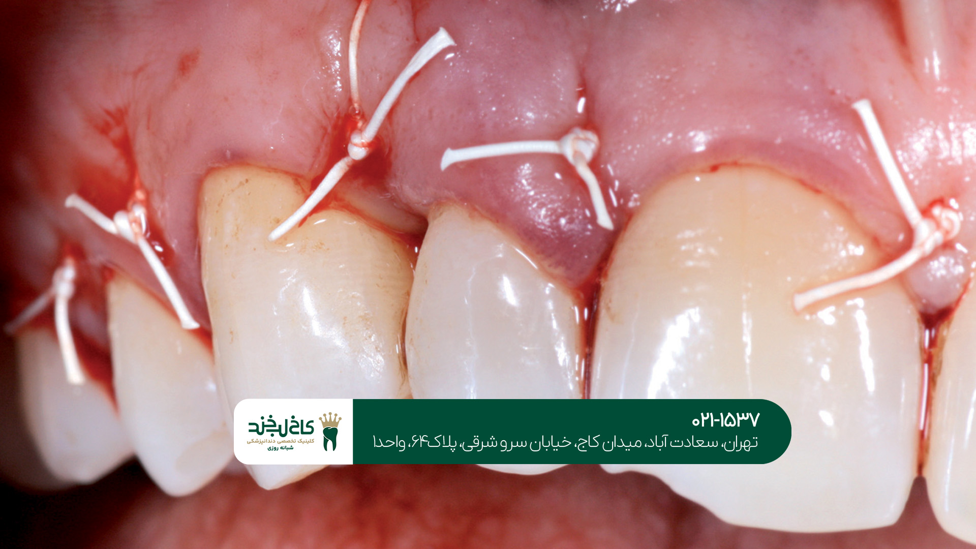 مهم‌ترین مراقبت‌های بعد از درمان دندان و جراحی لثه