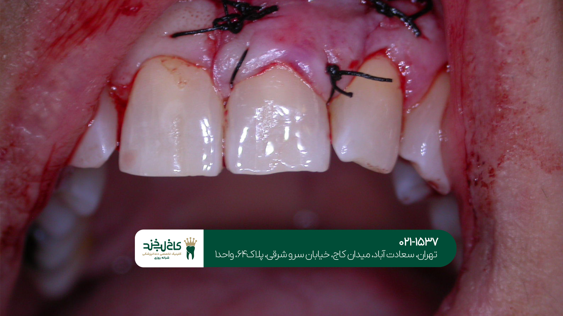 مهم‌ترین مراقبت‌های بعد از درمان دندان و جراحی لثه