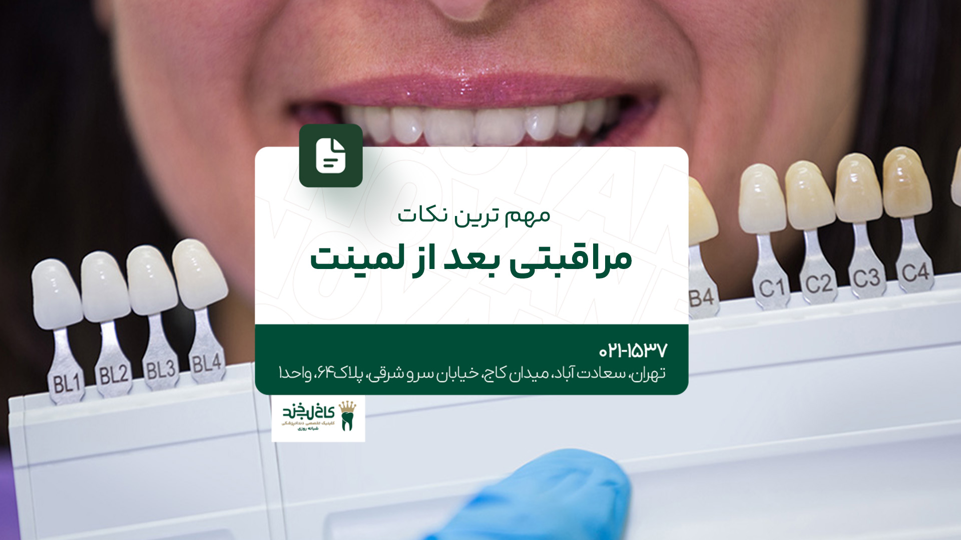 مهمترین نکات مراقبتی بعد از لمینت مهمترین نکات مراقبتی بعد از لمینت