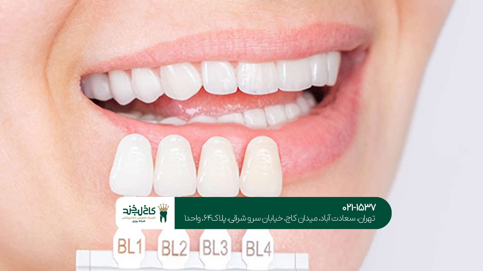 مهمترین نکات مراقبتی بعد از لمینت مهمترین نکات مراقبتی بعد از لمینت