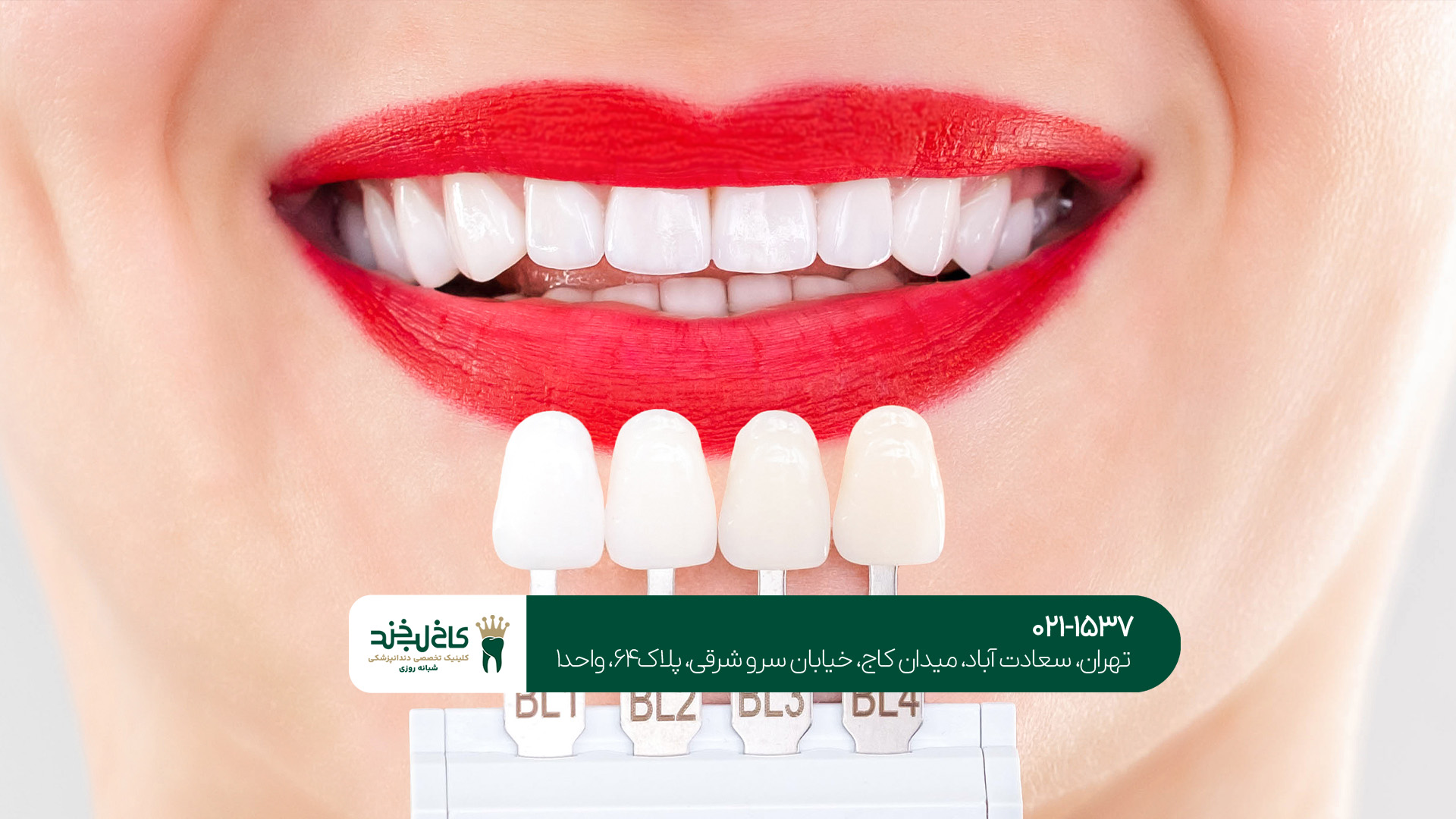 مهمترین نکات مراقبتی بعد از لمینت مهمترین نکات مراقبتی بعد از لمینت