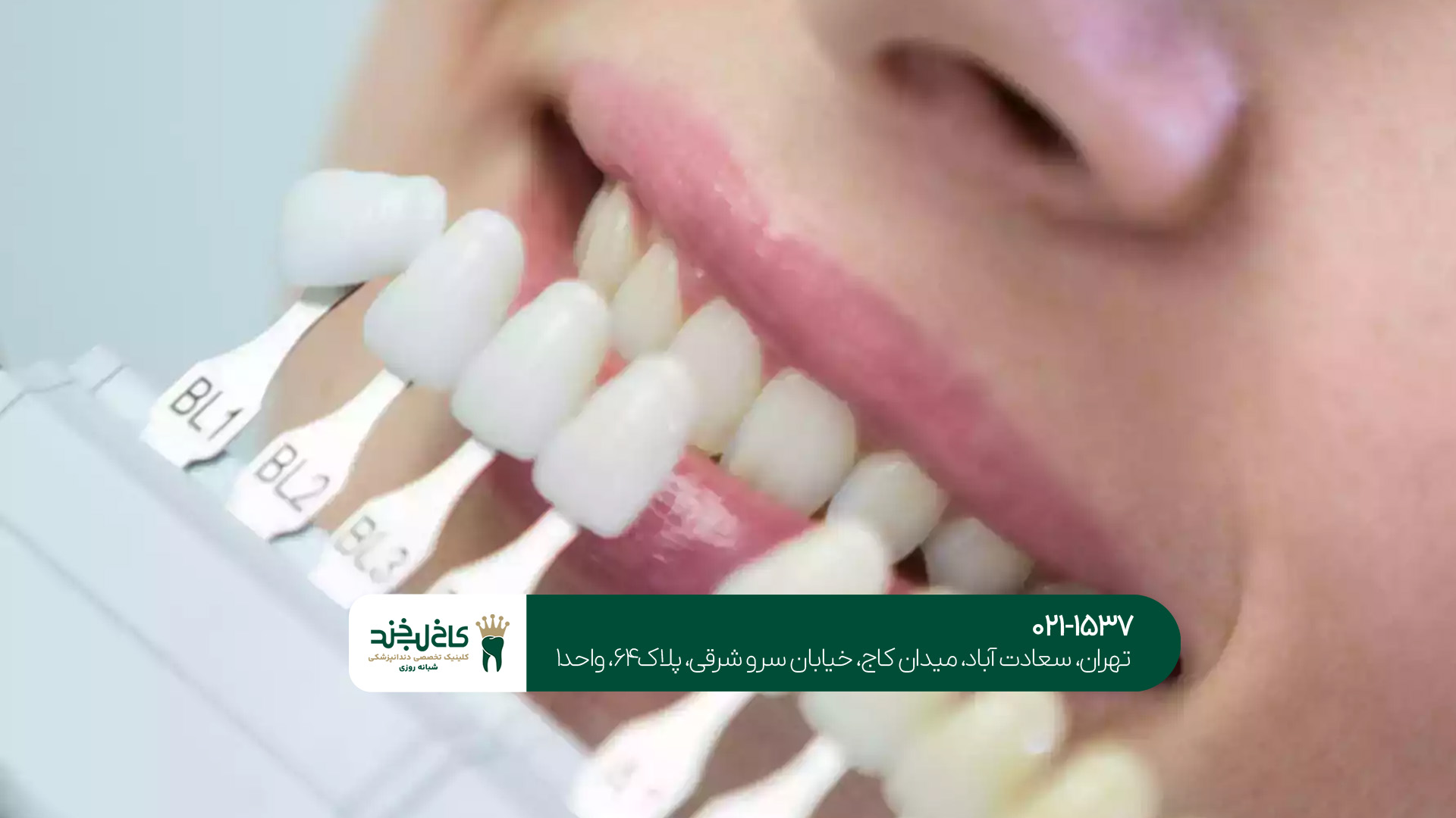 مهمترین نکات مراقبتی بعد از لمینت مهمترین نکات مراقبتی بعد از لمینت