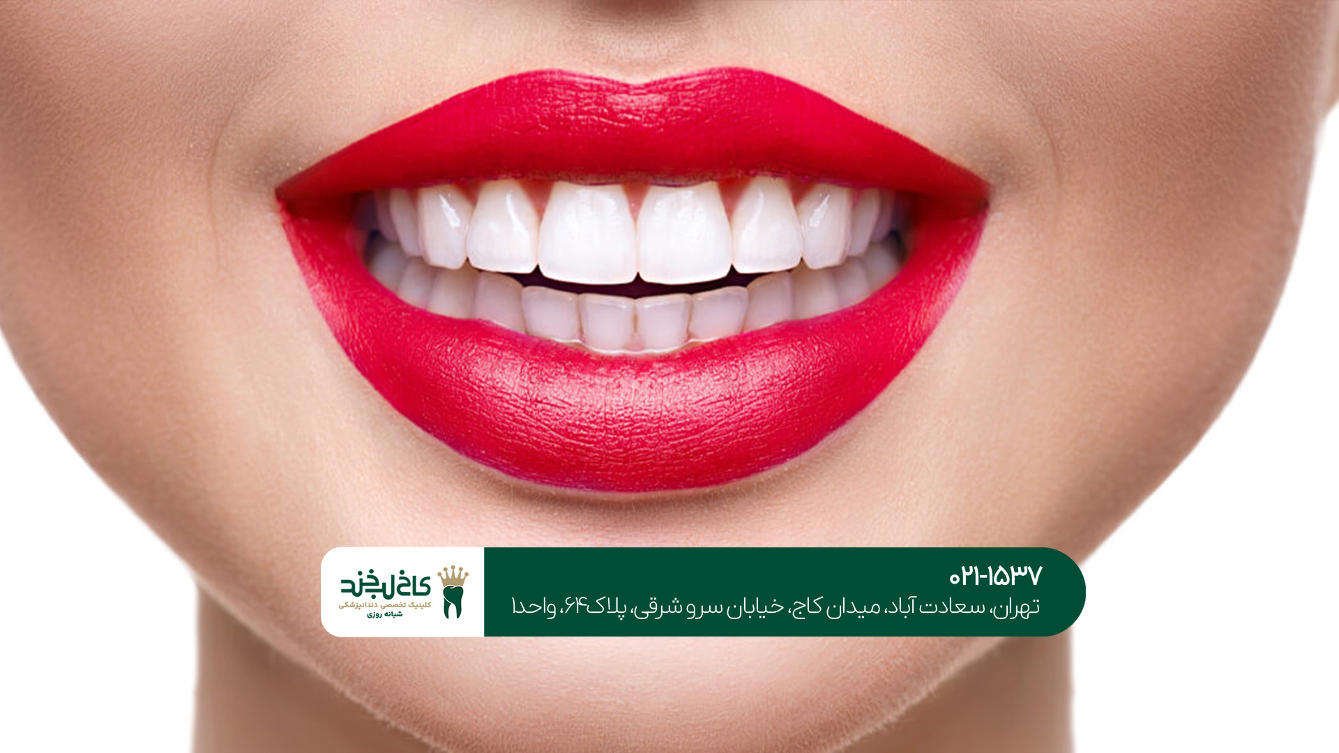 مراقبت های بعد از کامپوزیت مراقبت های بعد از کامپوزیت