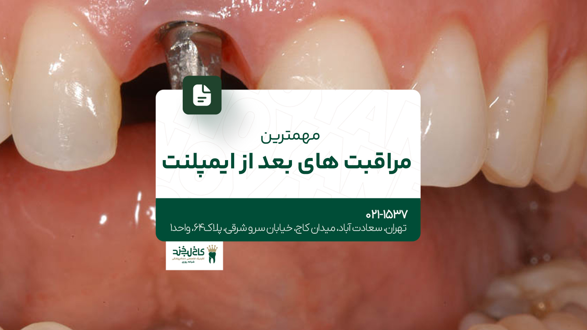 مهمترین مراقبت بعد از ایمپلنت دندان مهمترین مراقبت بعد از ایمپلنت دندان