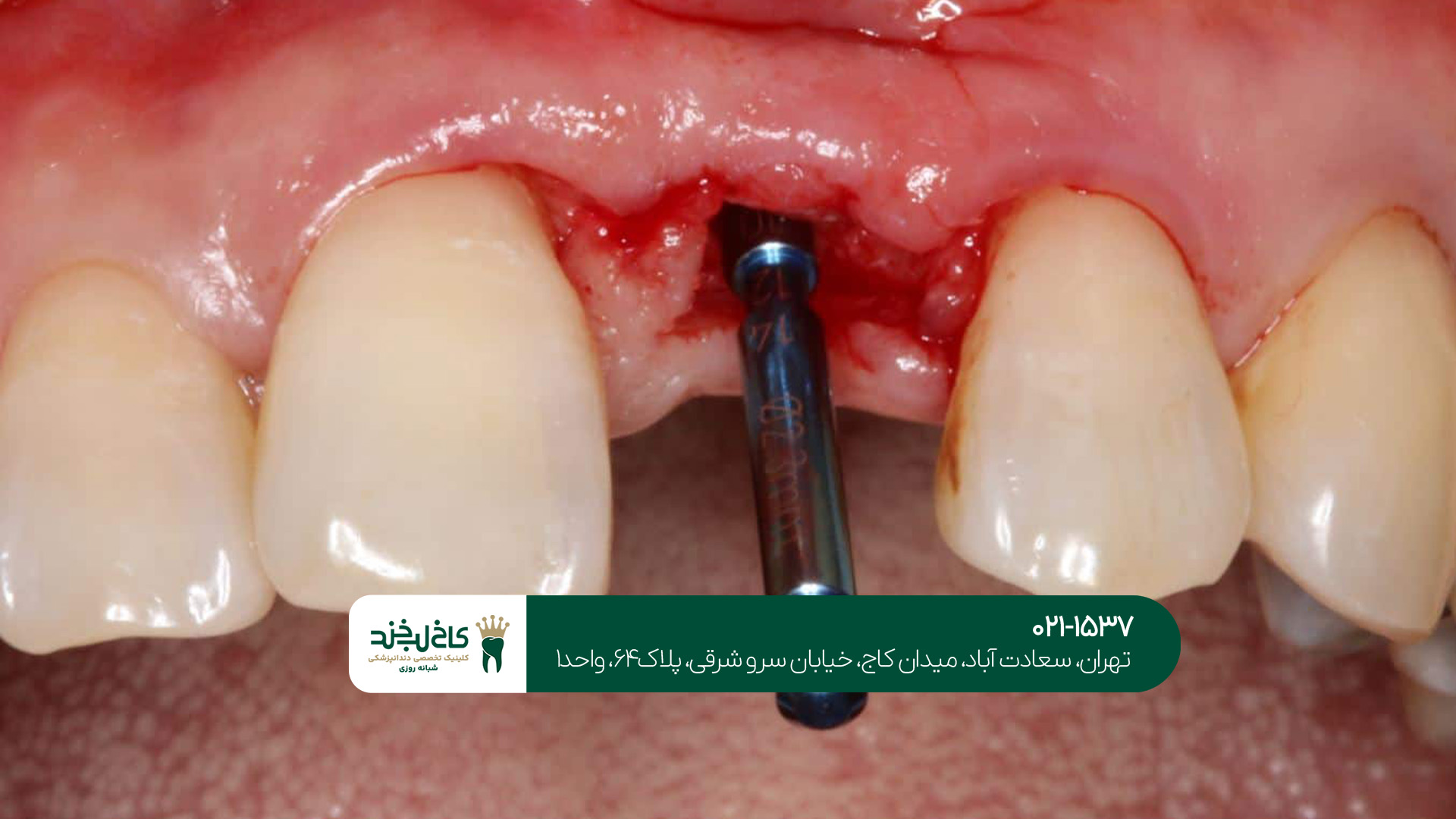 مهمترین مراقبت بعد از ایمپلنت دندان مهمترین مراقبت بعد از ایمپلنت دندان